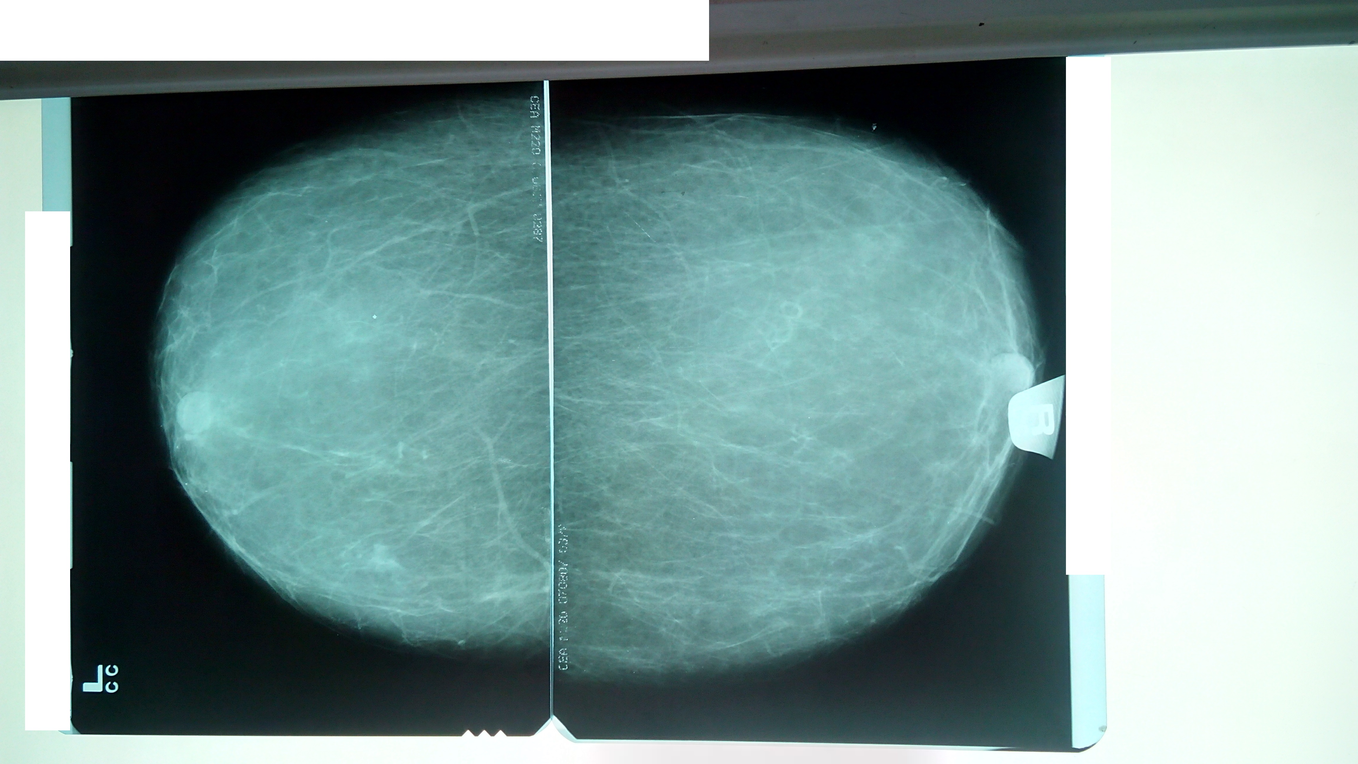 Маммография оренбург. Маммография молочных желез. Снимки маммографии молочных желез в норме.