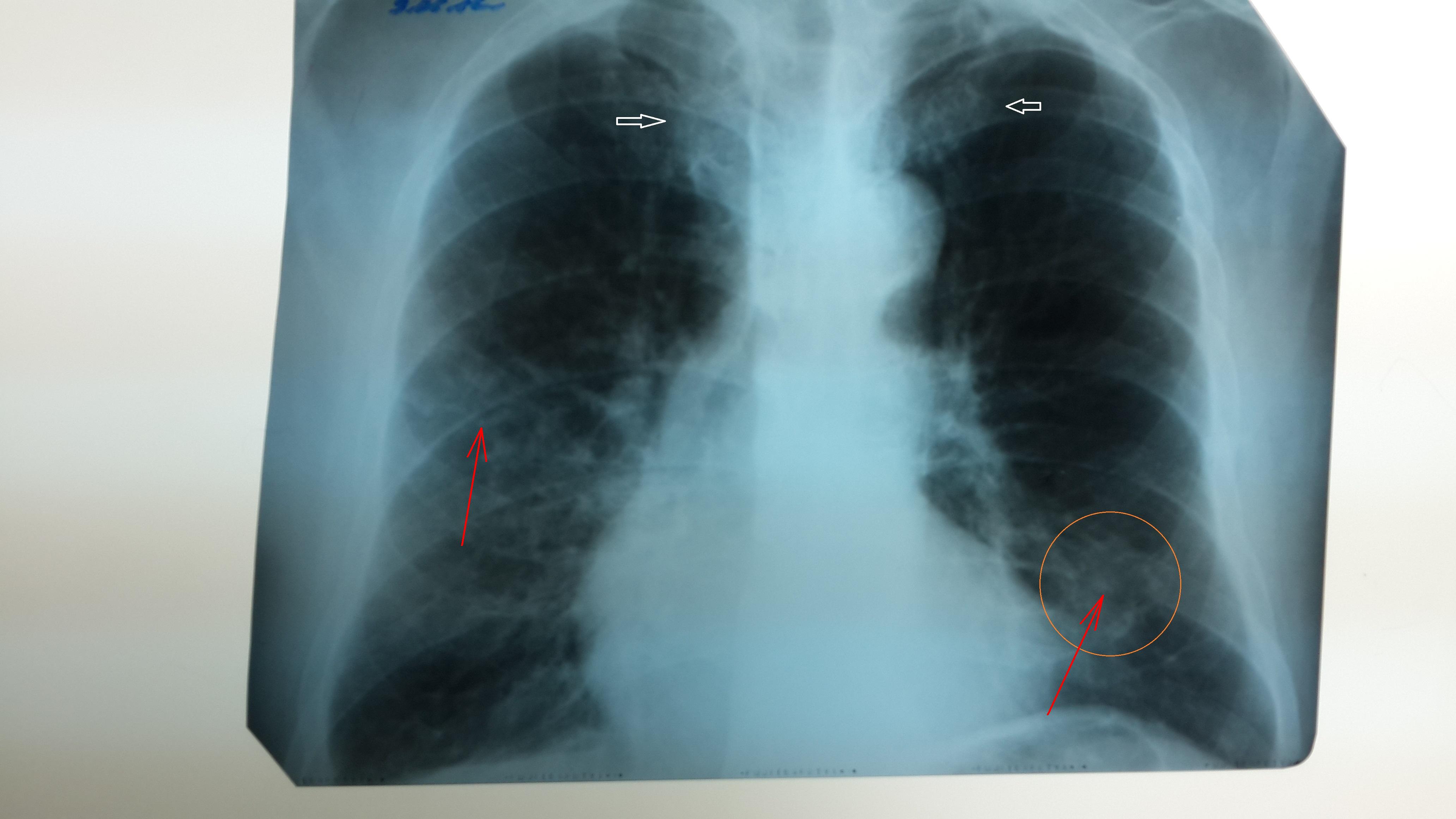 Рентген при двухсторонней пневмонии