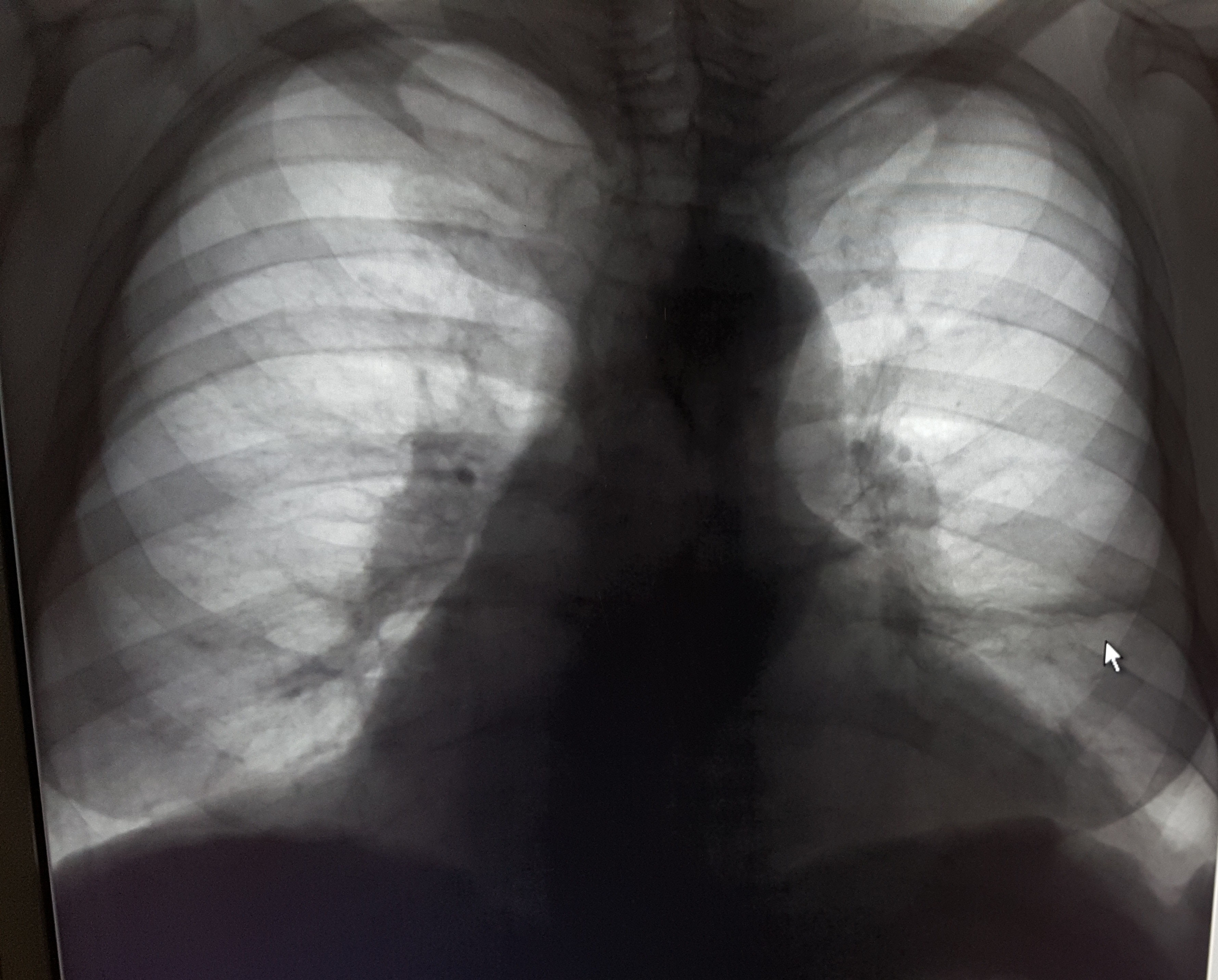 Чем опасны спайки в легких. Плевральная шварта рентген. Плевральная шварта справа рентген. Плевральная спайка рентген. Плевральная шварта слева рентген.