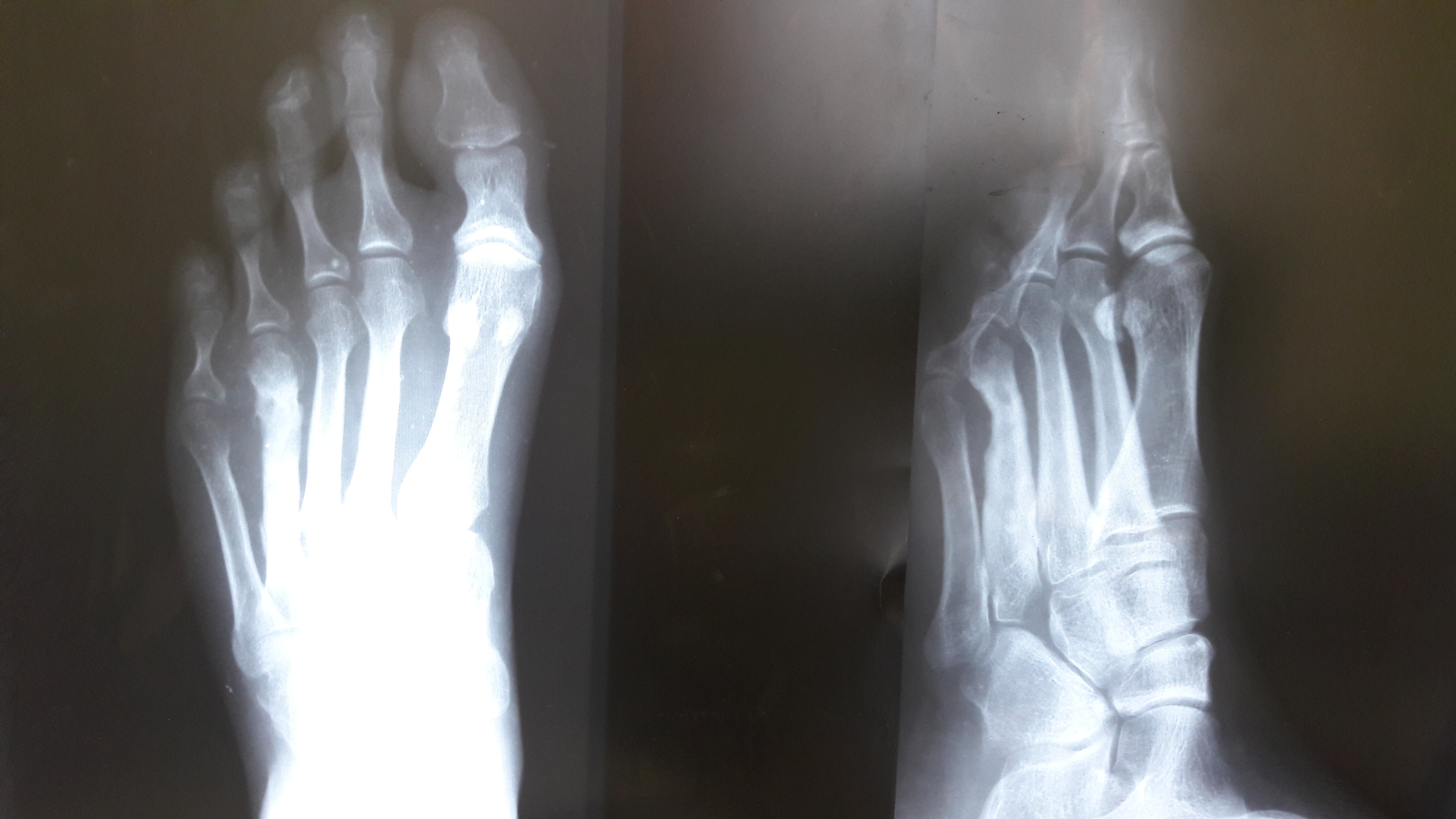 Трещина кости на ноге. Перелом 1 плюсневой кости. Перелом плюсневой кости 5 пальца. 4-5 Плюсневая кость стопы. Рентген плюсневой кости стопы.