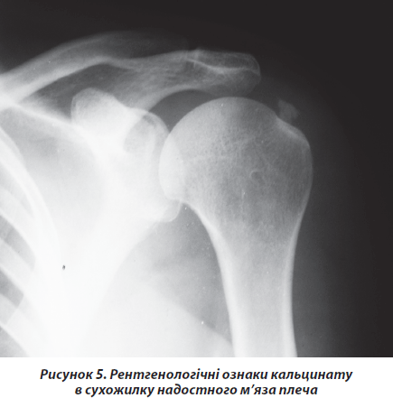 Бурсит плечевого сустава. Кальцинирующий тендинит плечевого сустава рентген. Обызвествление связок плечевого сустава рентген. Оссифицирующий бурсит плечевого сустава рентген.