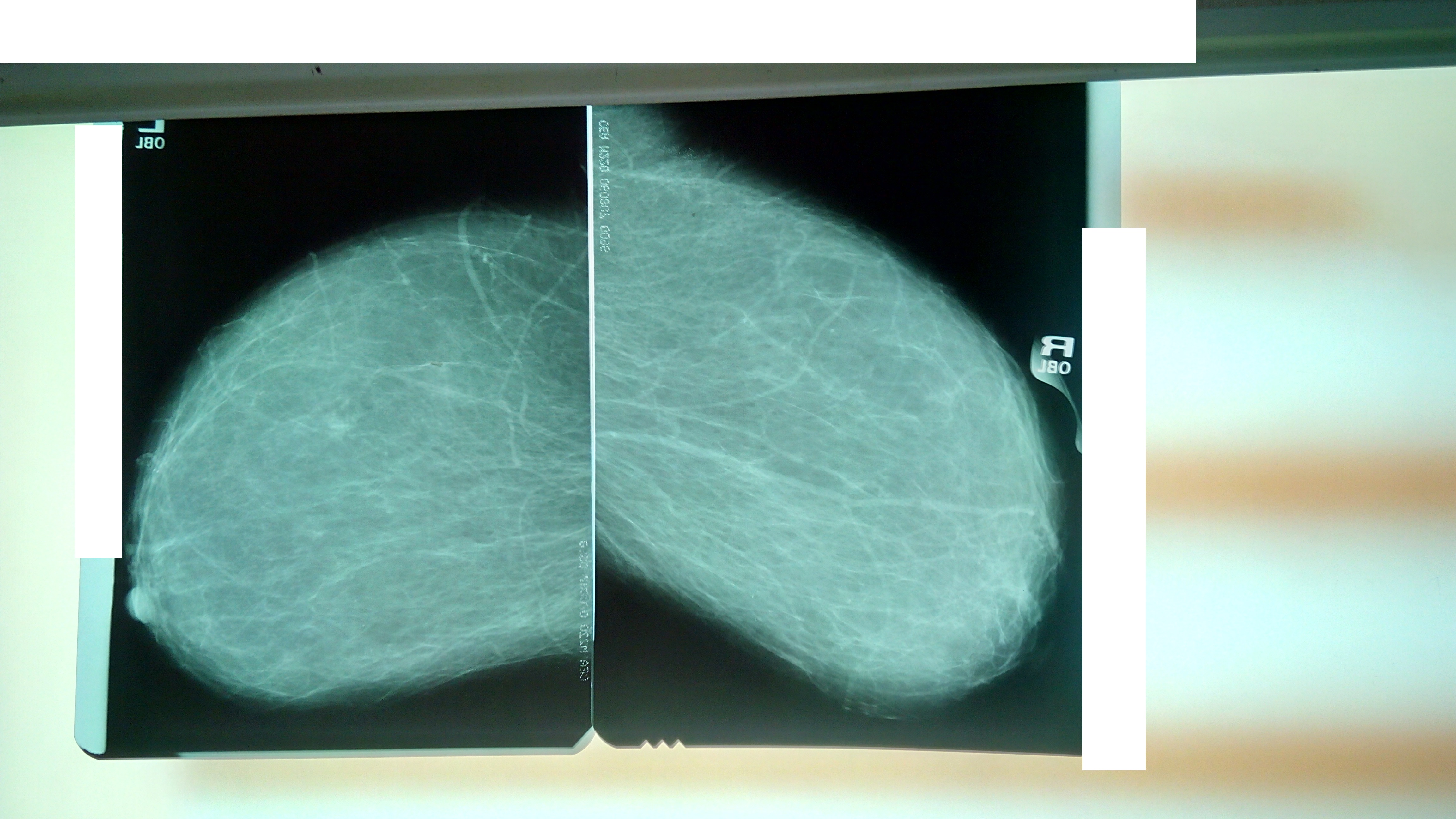 Маммография норма рентген