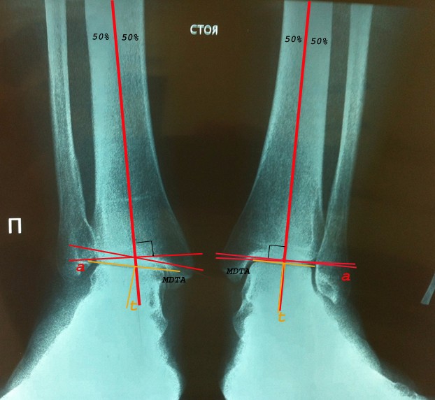 Вальгусная деформация стопы рентген фото