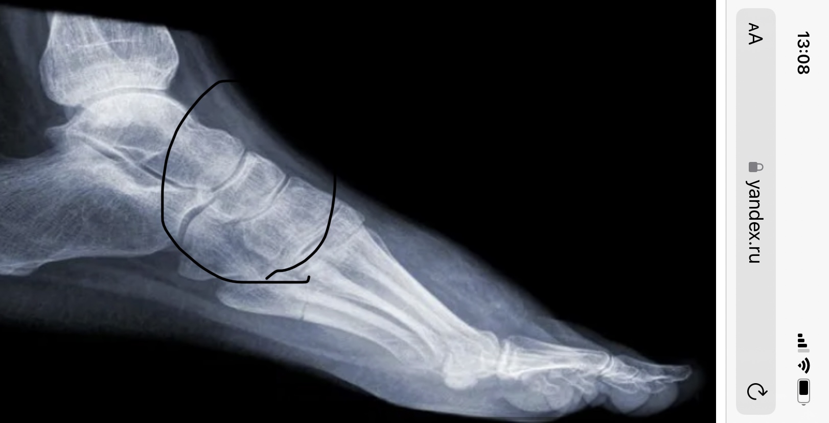 Причины вальгусной деформации пальцев стопы