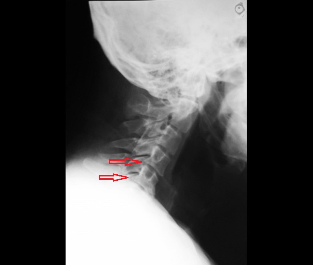 Заклинило шею больно поворачивать что делать. Врожденная мышечная кривошея рентген. Костная кривошея на рентгене. Кривошея на рентгенограмме.