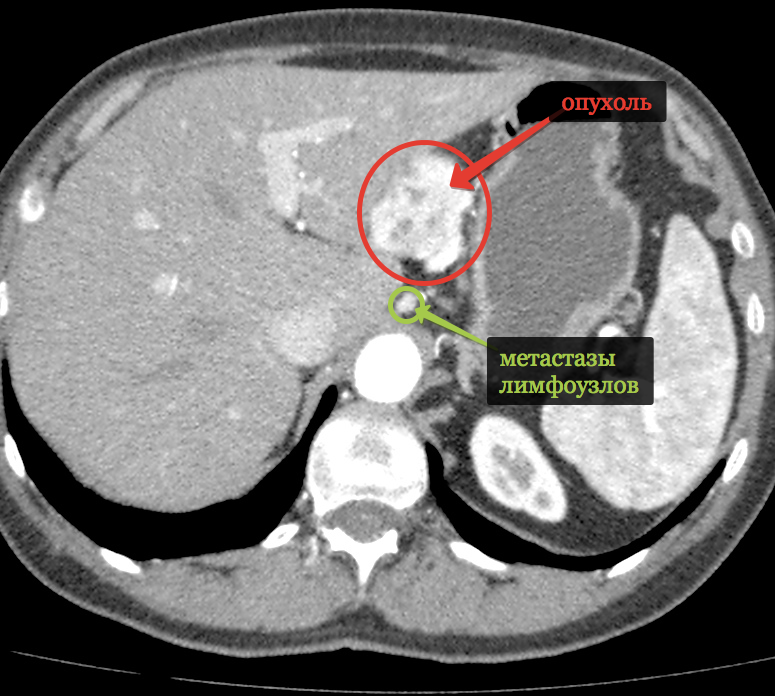 Метастазированные лимфоузлы. Нейроэндокринная опухоль желудка на кт. Нейроэндокринная опухоль поджелудочной железы кт картина. Кт брюшной полости метастазы. Забрюшинные лимфатические узлы на кт.