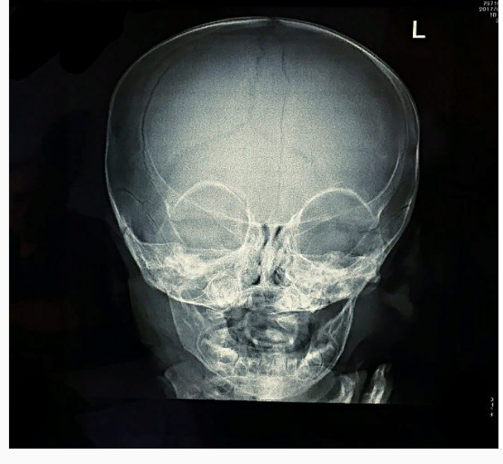 Метопический шов рентген. Метопический шов черепа. Рентгенограмма черепа новорожденного. Рентгенография черепа швы. Детский череп рентген