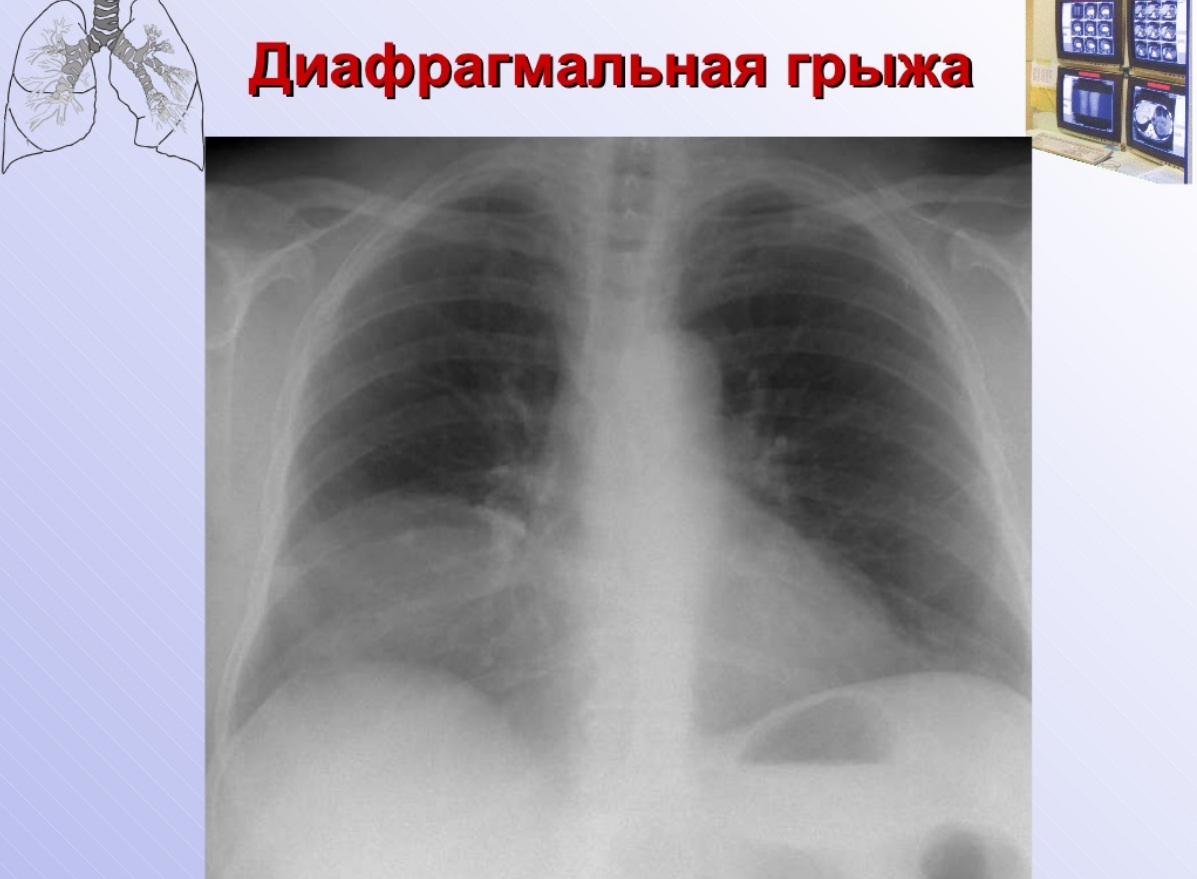 Диафрагмальная грыжа. Диафрагмальная грыжа рентген. Врожденная диафрагмальная грыжа рентген. Истинная диафрагмальная грыжа рентген. Ложная диафрагмальная грыжа рентген.