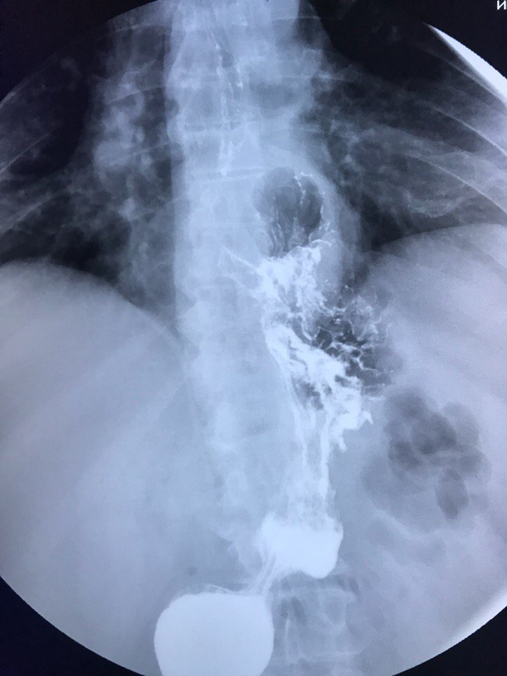 Грыжа пищевода рентген. Диафрагмальная грыжа пищеводного отверстия. Параэзофагеальная грыжа пищеводного отверстия диафрагмы рентген. Скользящая грыжа ГПОД рентген.
