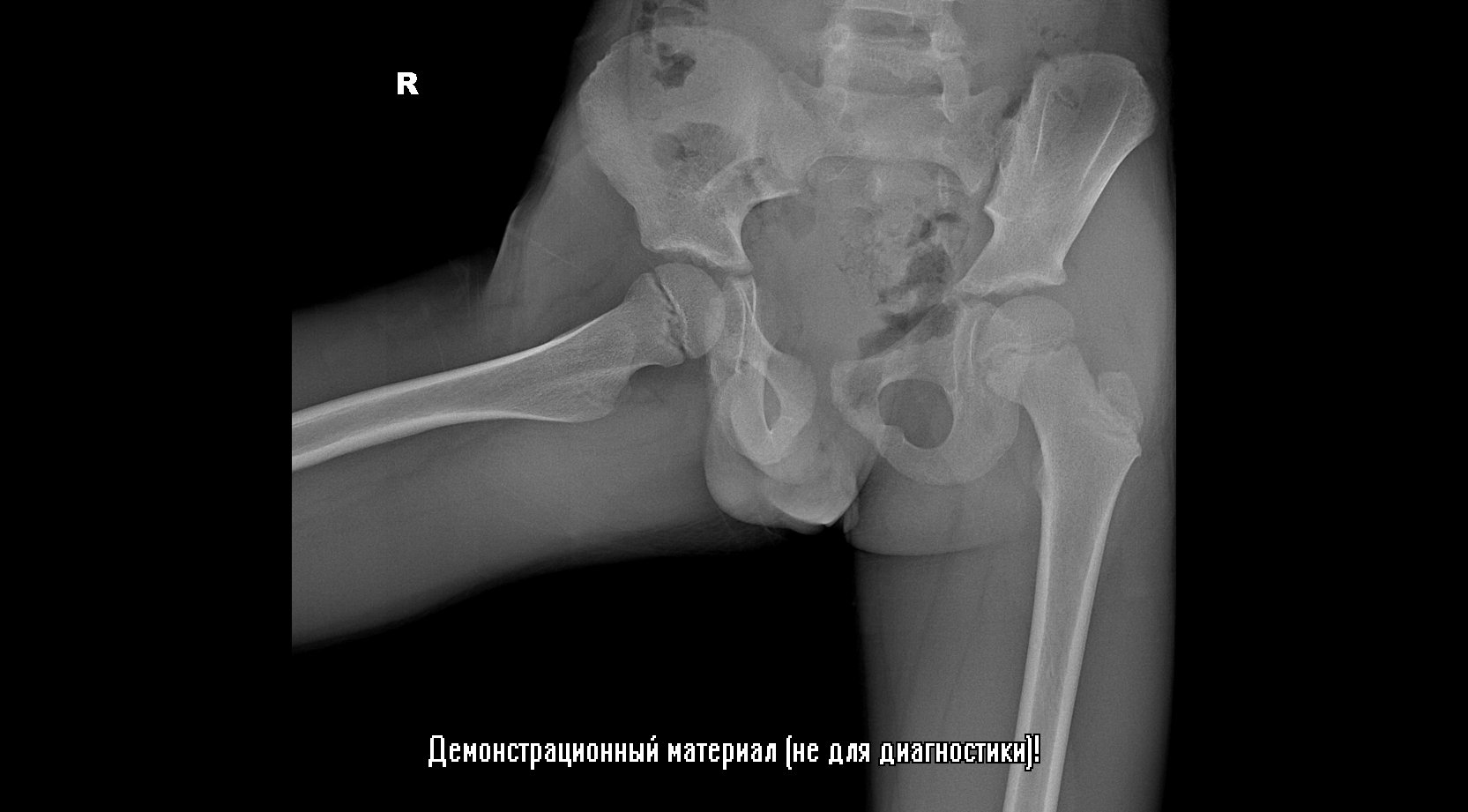 Рентгенография тазобедренного сустава