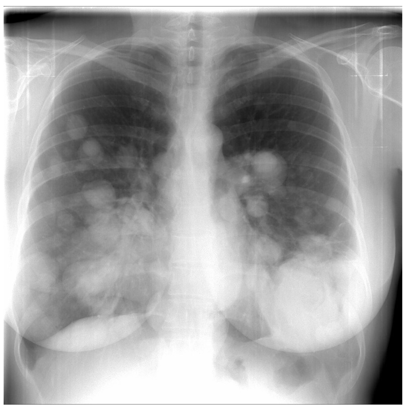 Затемнение нижних легких. Шаровидная пневмония рентген. Метастазы в лёгких на рентгене. Вирусная пневмония рентген. Снимок лёгких при бронхите.