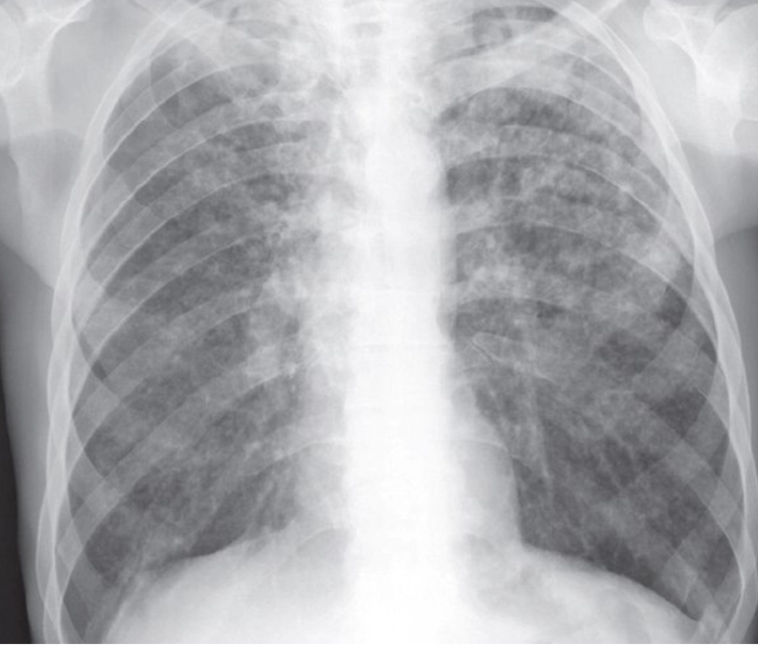 Туберкулез верхушек легких рентген