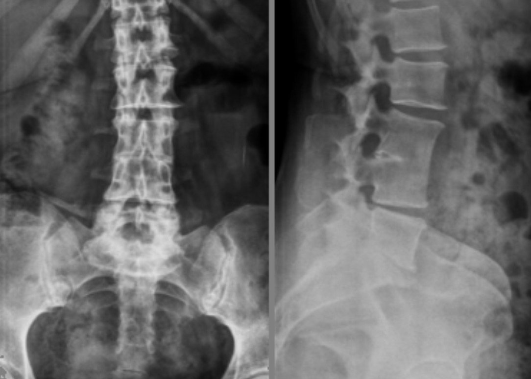 Конкресценция позвонков. Спондилолиз l5 позвонка. Спондилолиз l5 рентген. Конкресценция с4-с5. Конкресценция позвонков шейного отдела рентген.
