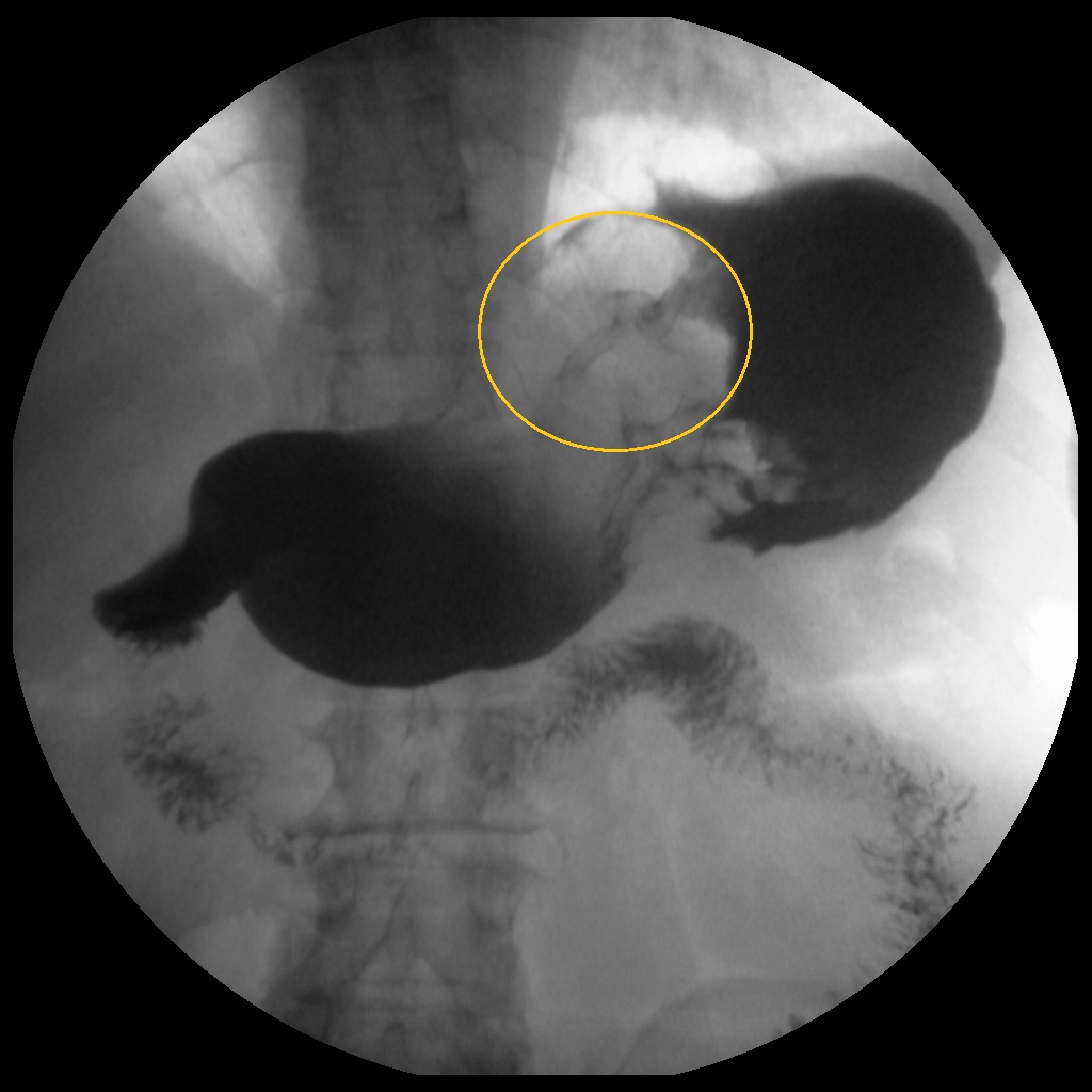 Рентген с барием пищевода и желудка подготовка. Рентгеноскопия желудка на трохоскопе что это такое. Протокол рентгеноскопии желудка. Рентгеноскопія шлунка свиней. Как делается рентгеноскопия желудка с барием.