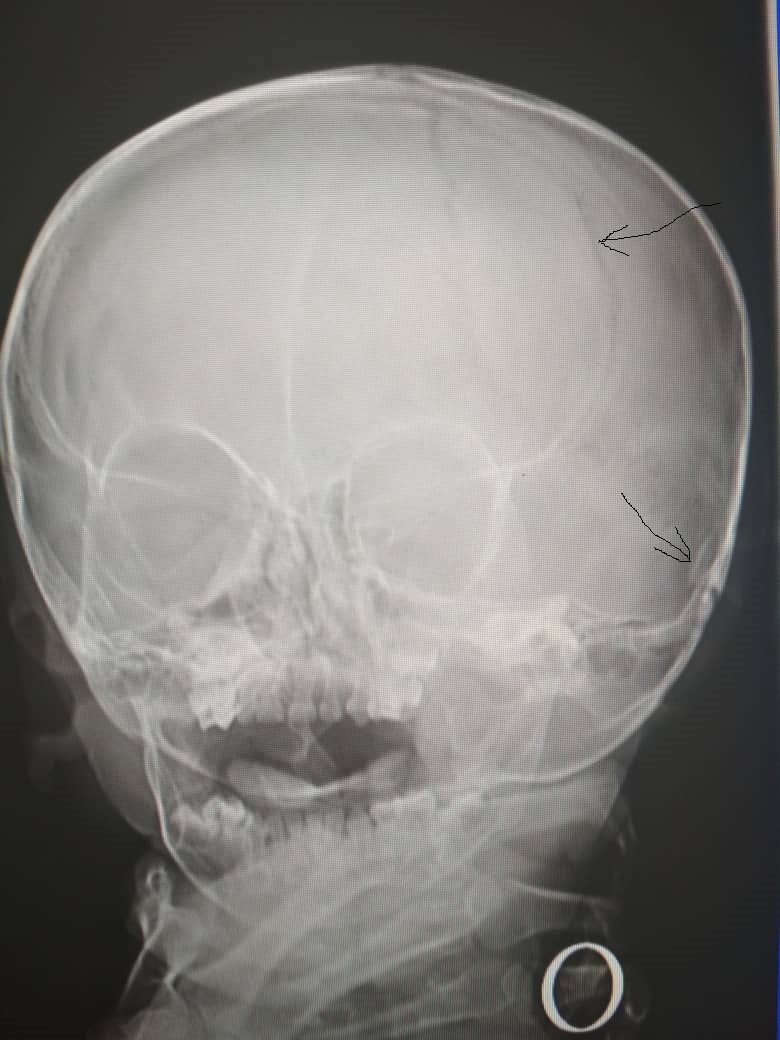 Детский череп рентген. Ахондроплазия рентген черепа. Перелом костей черепа рентген. Рентгенография черепа ребенка.