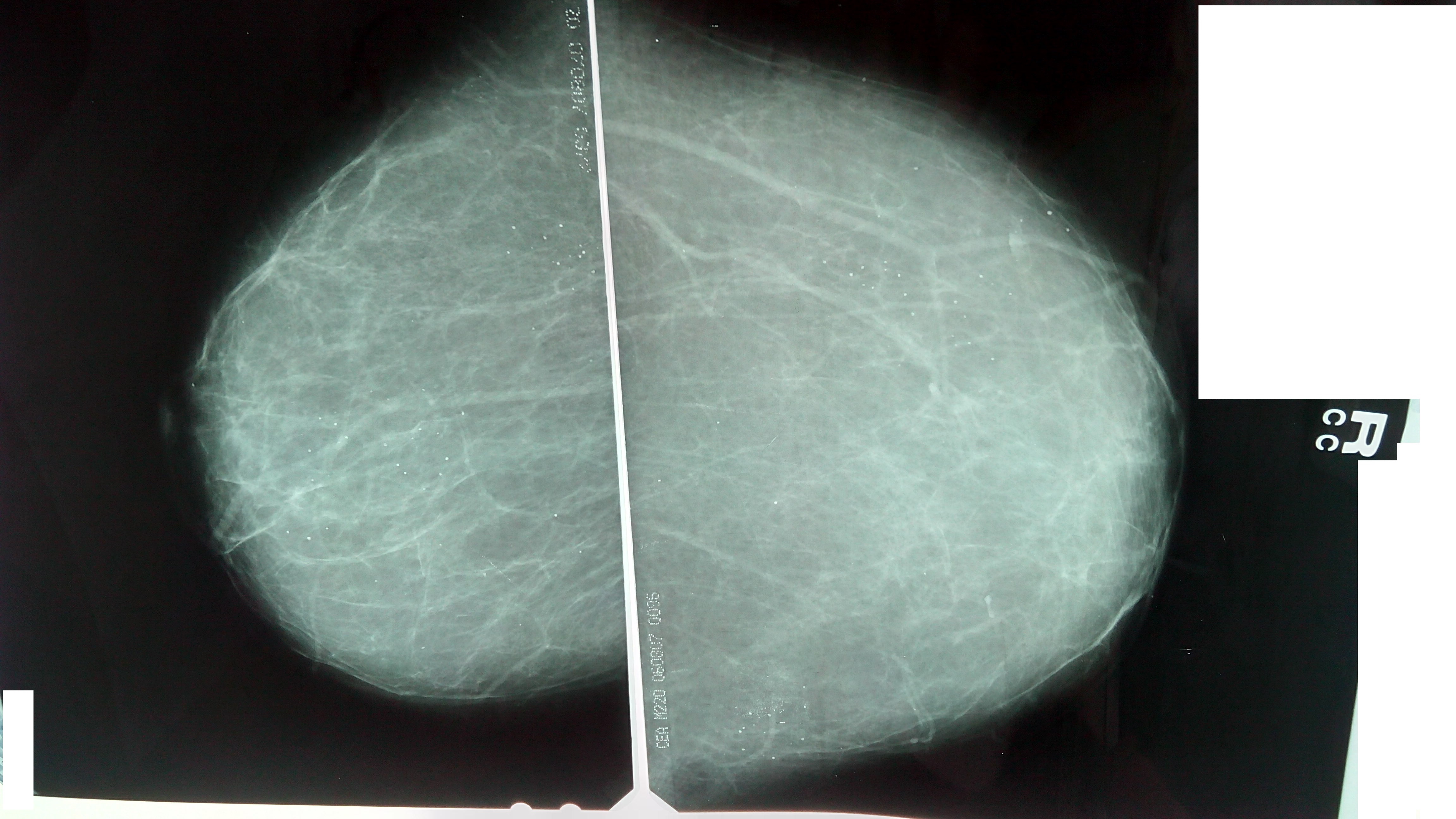 Маммография молочных желез 4. Фиброаденоз маммография. Галактоцеле на маммографии. Маммография жировая инволюция.