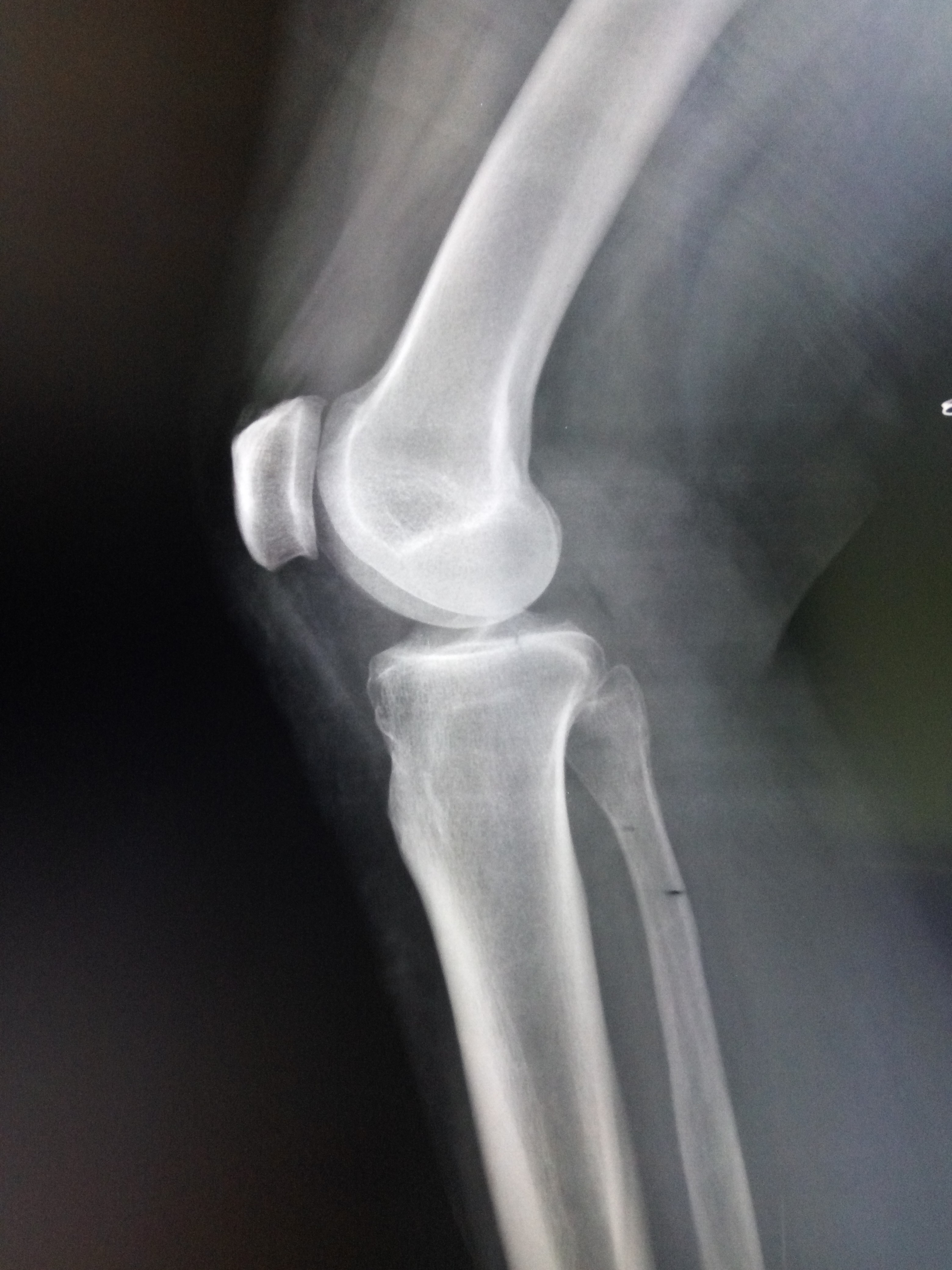 Перелом бугристости большеберцовой кости рентген
