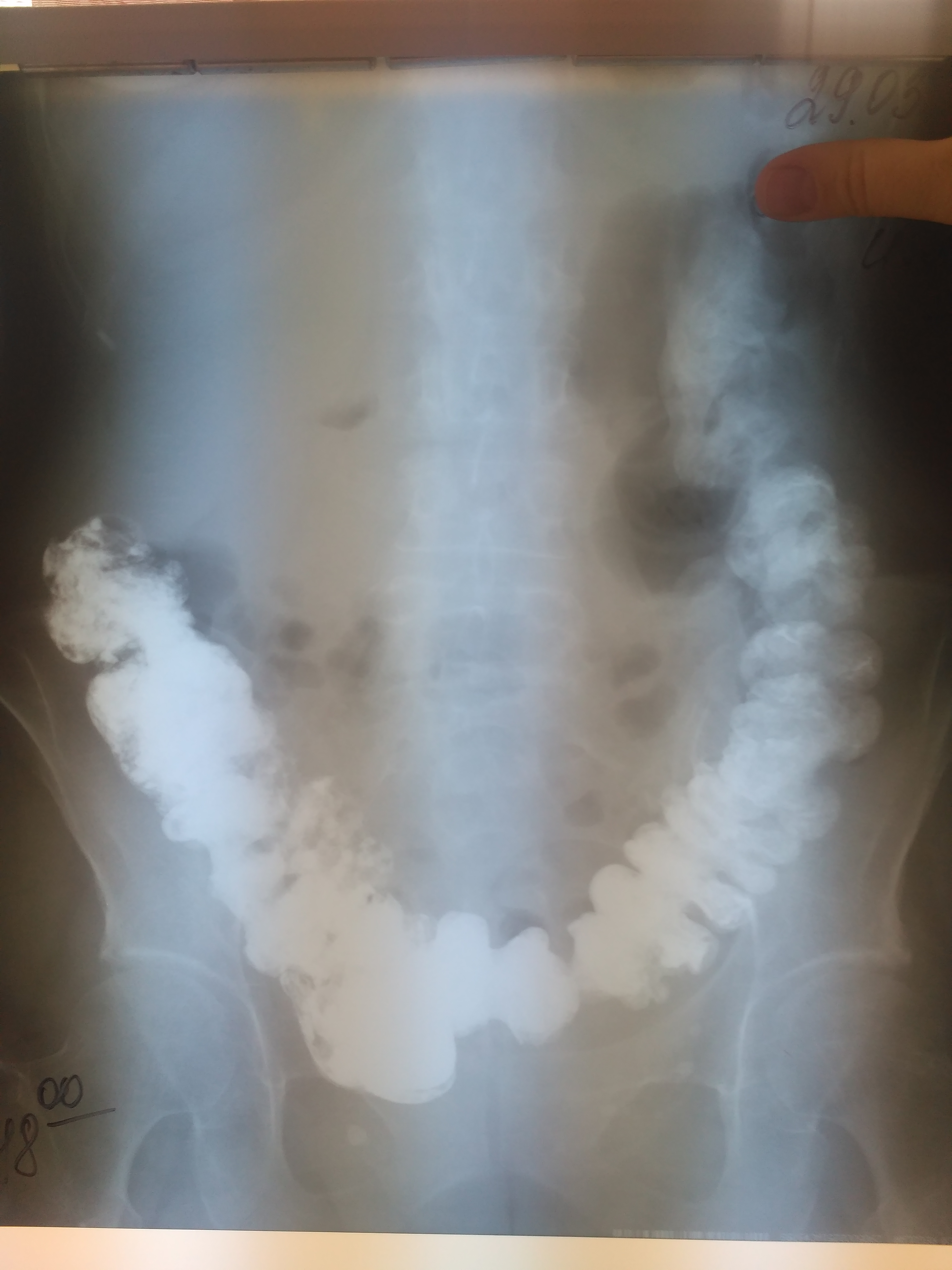 Пассаж кишки. Толстокишечная непроходимость рентген Пассаж бария. Пассаж бария по кишечнику рентген.