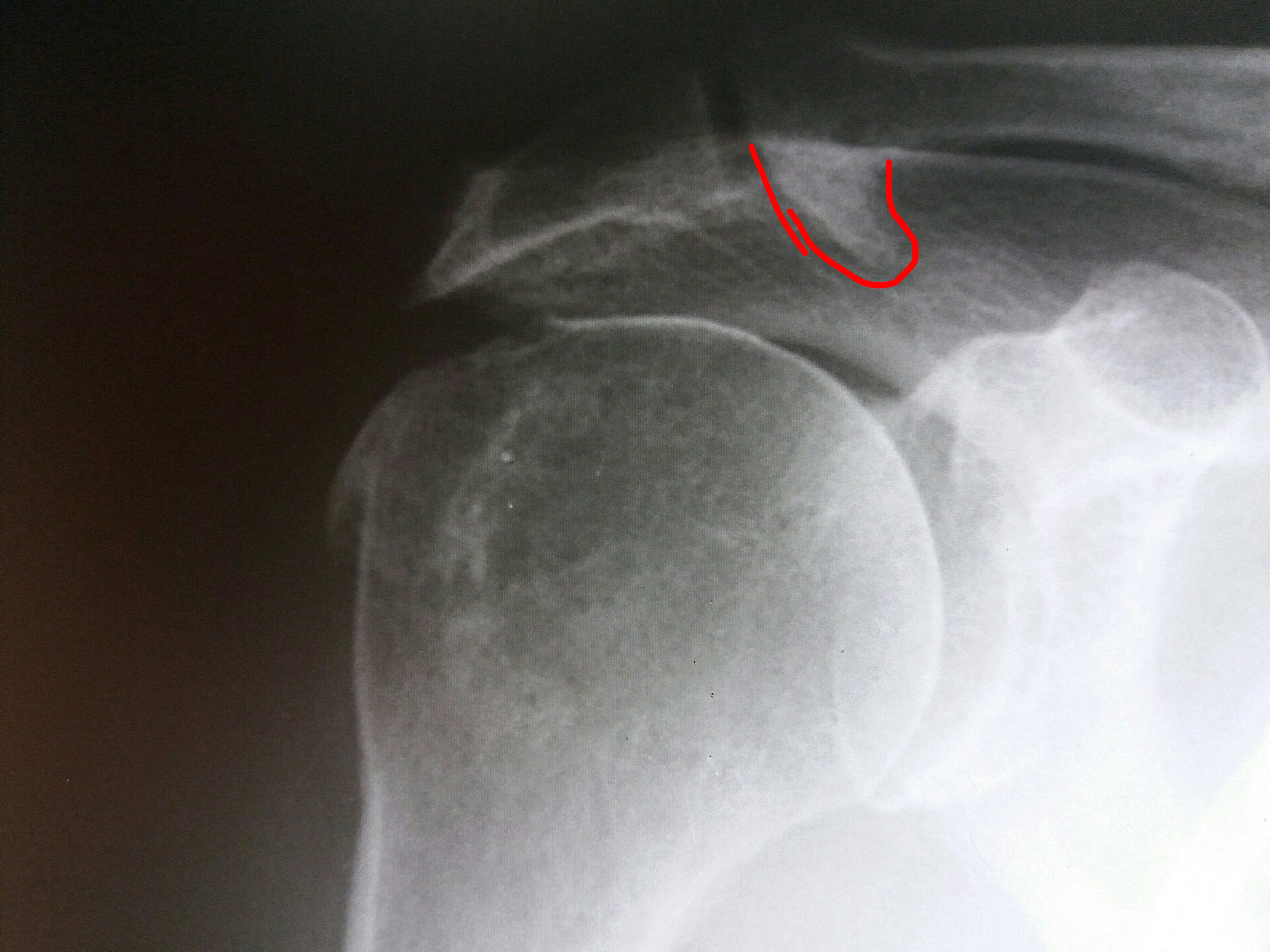 Перелом большого бугорка плечевой кости без смещения фото