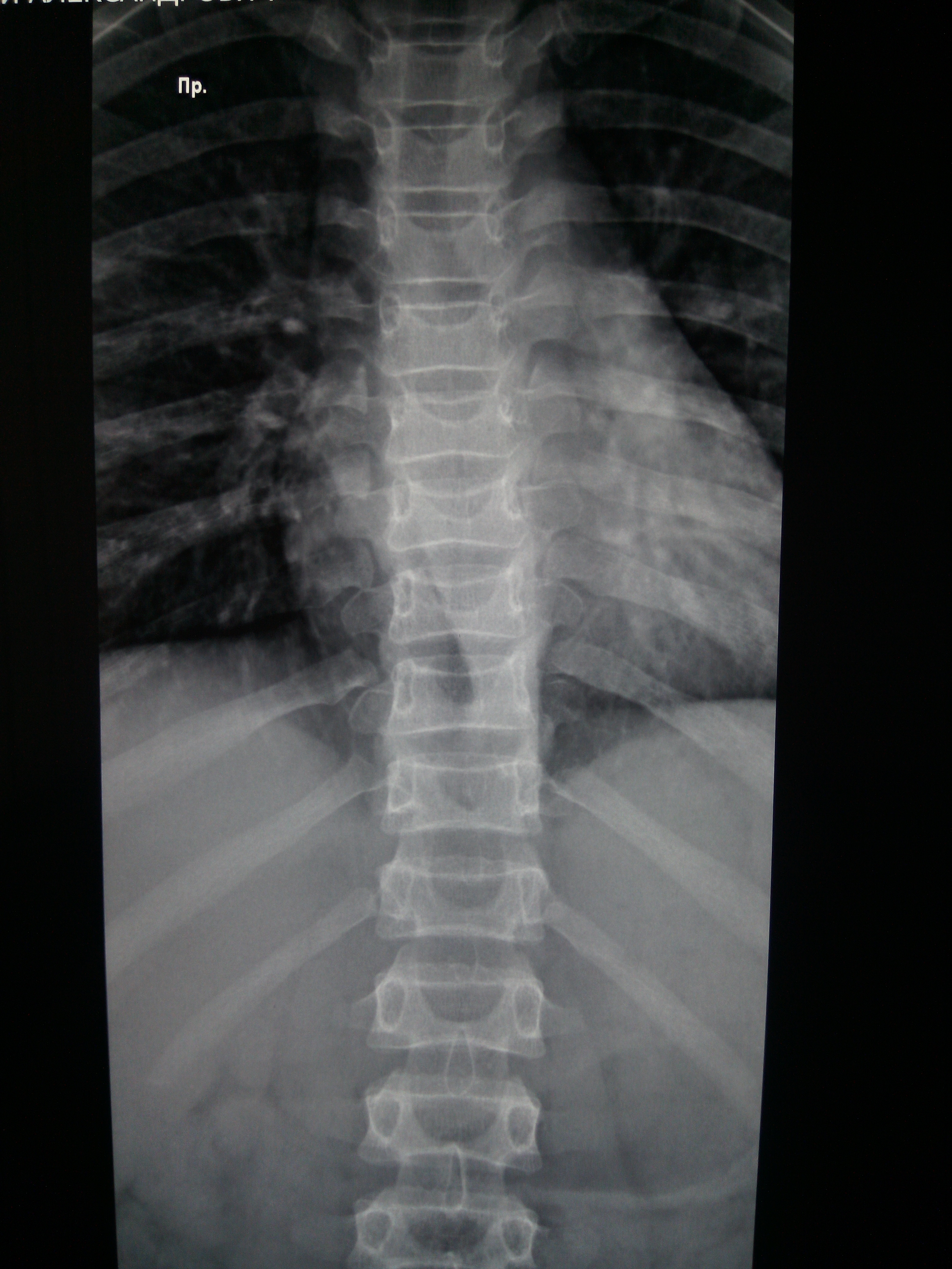 Рентгенография грудного отдела позвоночника