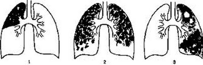 Казеозная пневмония схема