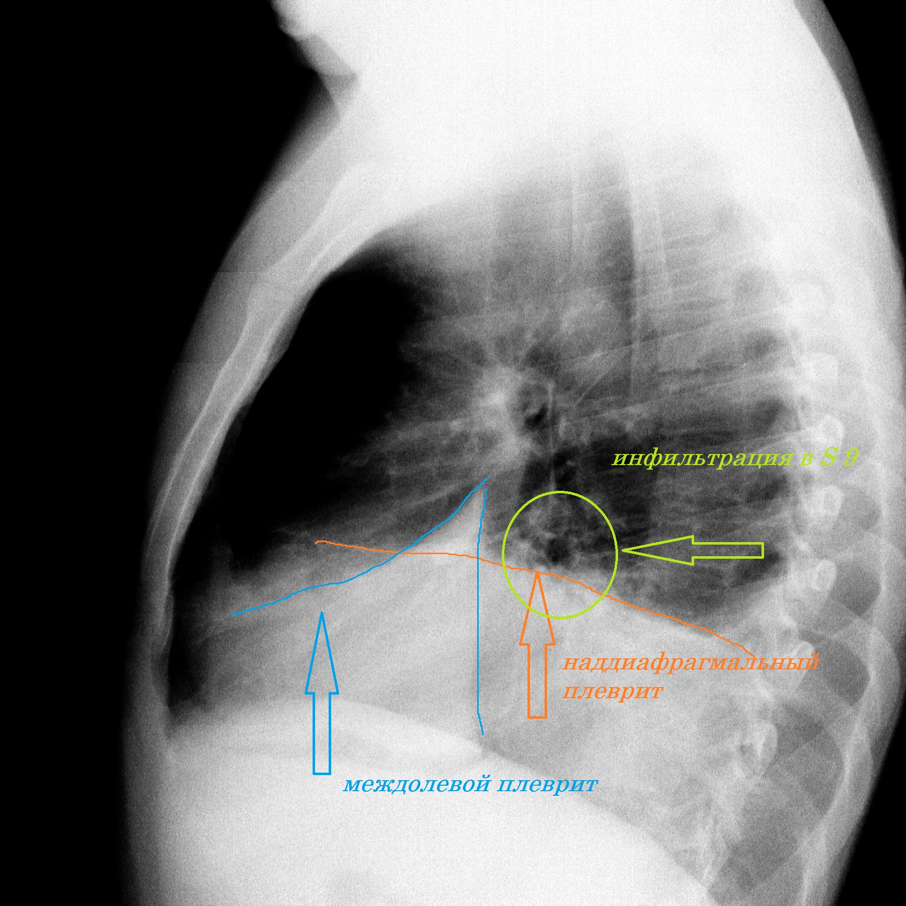 Плеврит боковая проекция