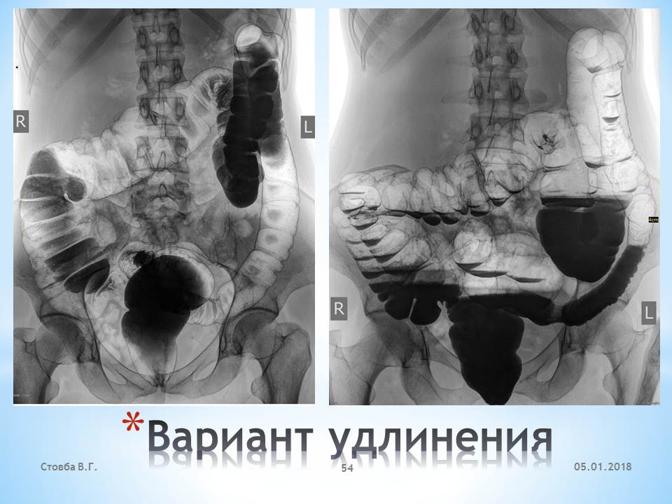 Ирригоскопия почек. Ирригоскопия заключение.