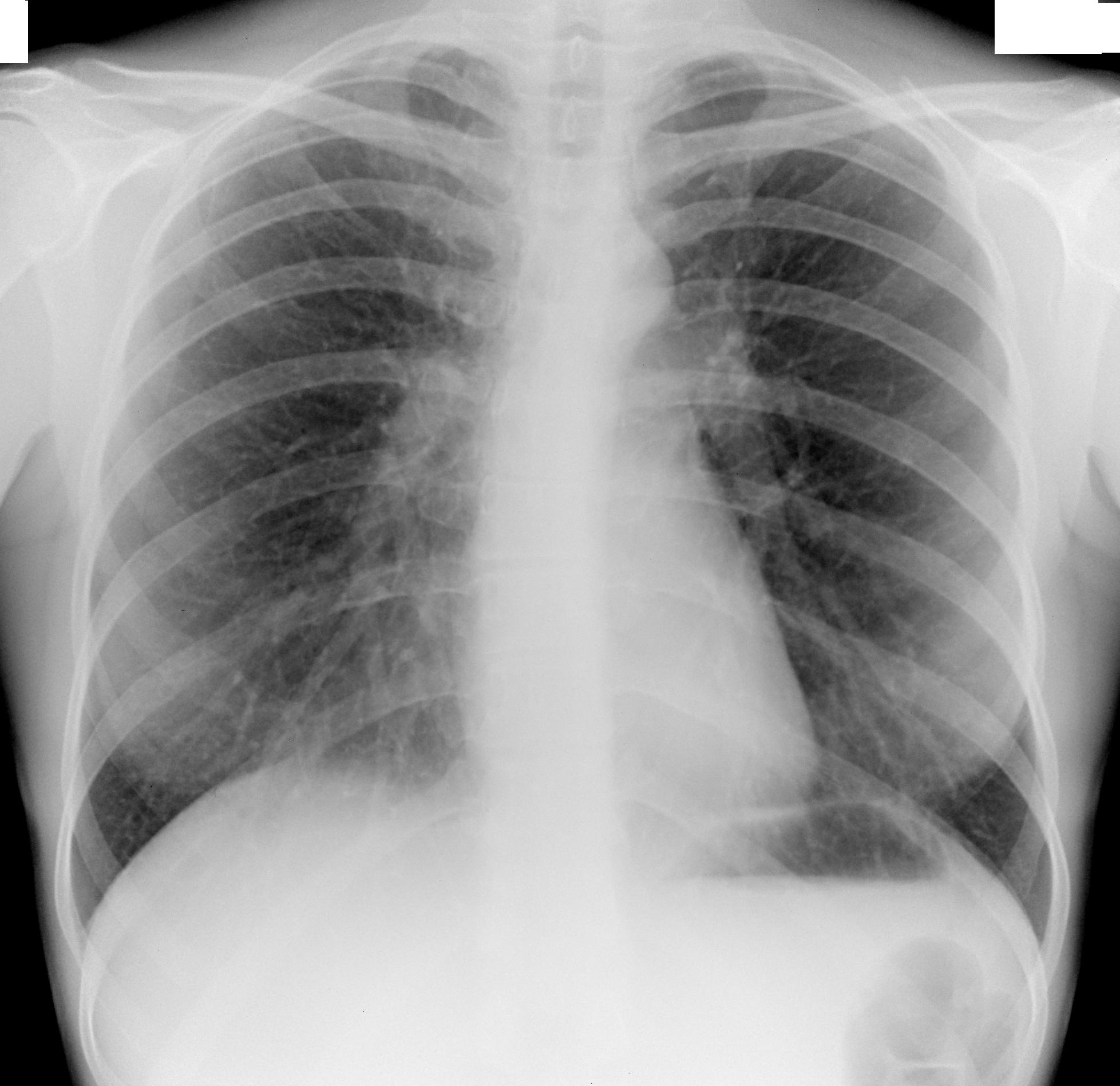 Рентген здоровых легких фото у взрослых