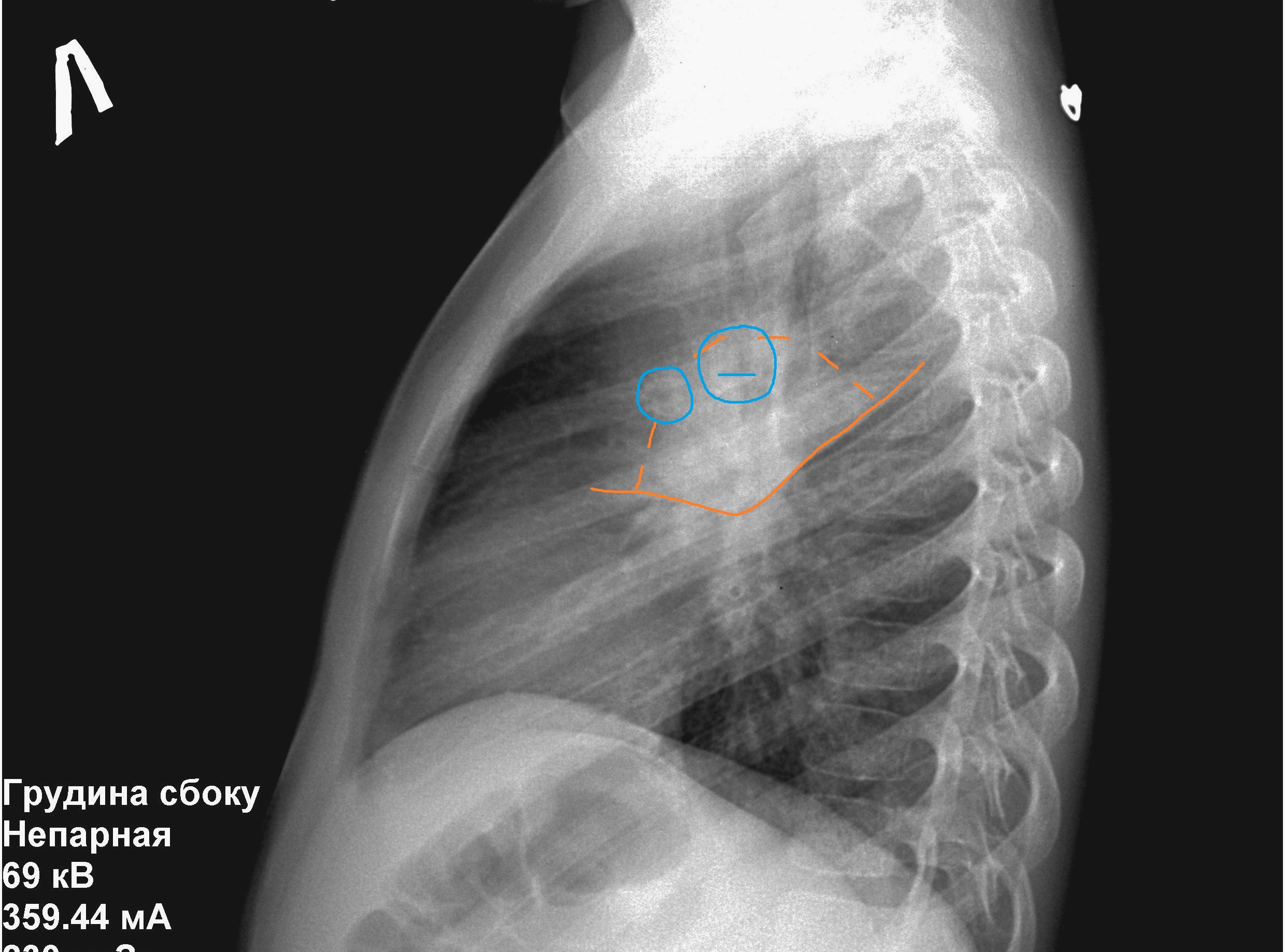 Боковая проекция. Рентген ОГК боковая проекция. Рентген грудной клетки боковая проэк.