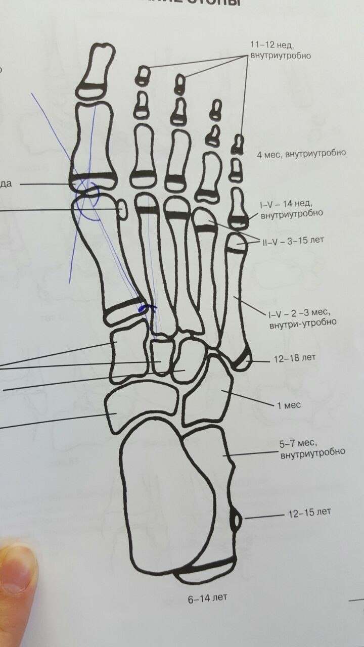Кости ног ребенка. Апофиз 5 плюсневой кости у детей. Апофизит 5 плюсневой кости стопы. Персистирующий Апофиз 5 плюсневой кости. Зона роста 5 плюсневая кость.
