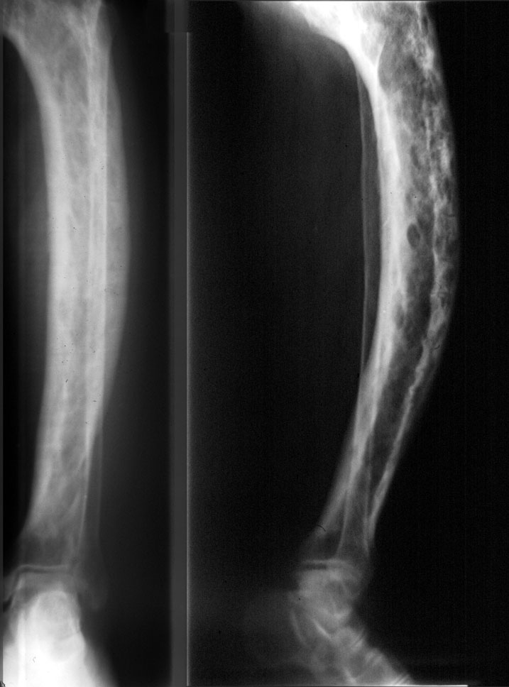 Болезнь педжета. Остеодистрофия Педжета. Болезнь Педжета костей рентген. Деформирующий остоз (болезнь Педжета).. Остеохондрит длинных трубчатых костей Вегнера.