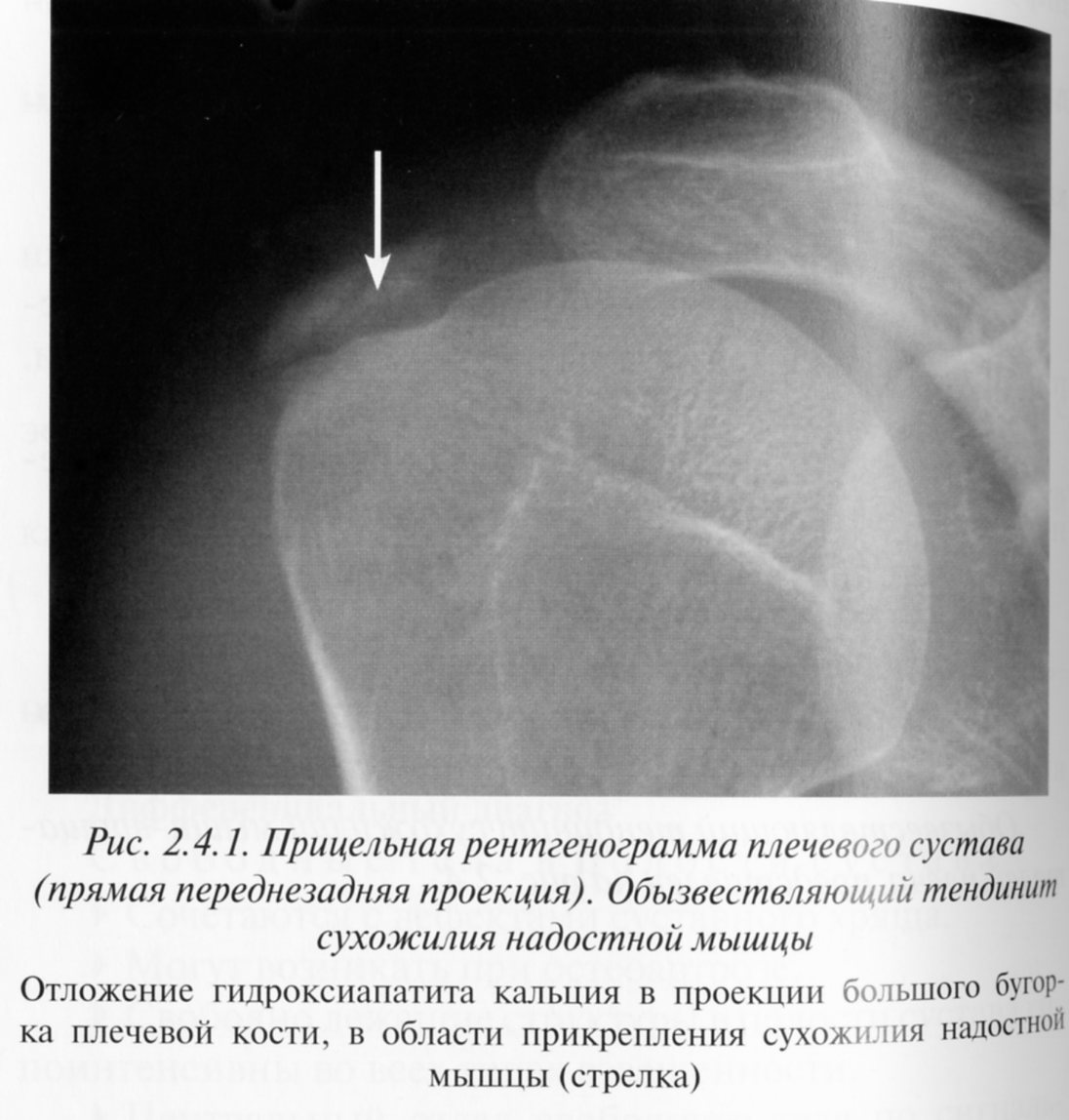 Тендиноз плечевого сустава рентген