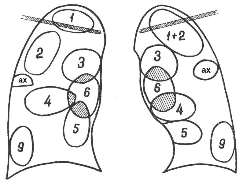 Сегменты легких на рентгенограмме схема