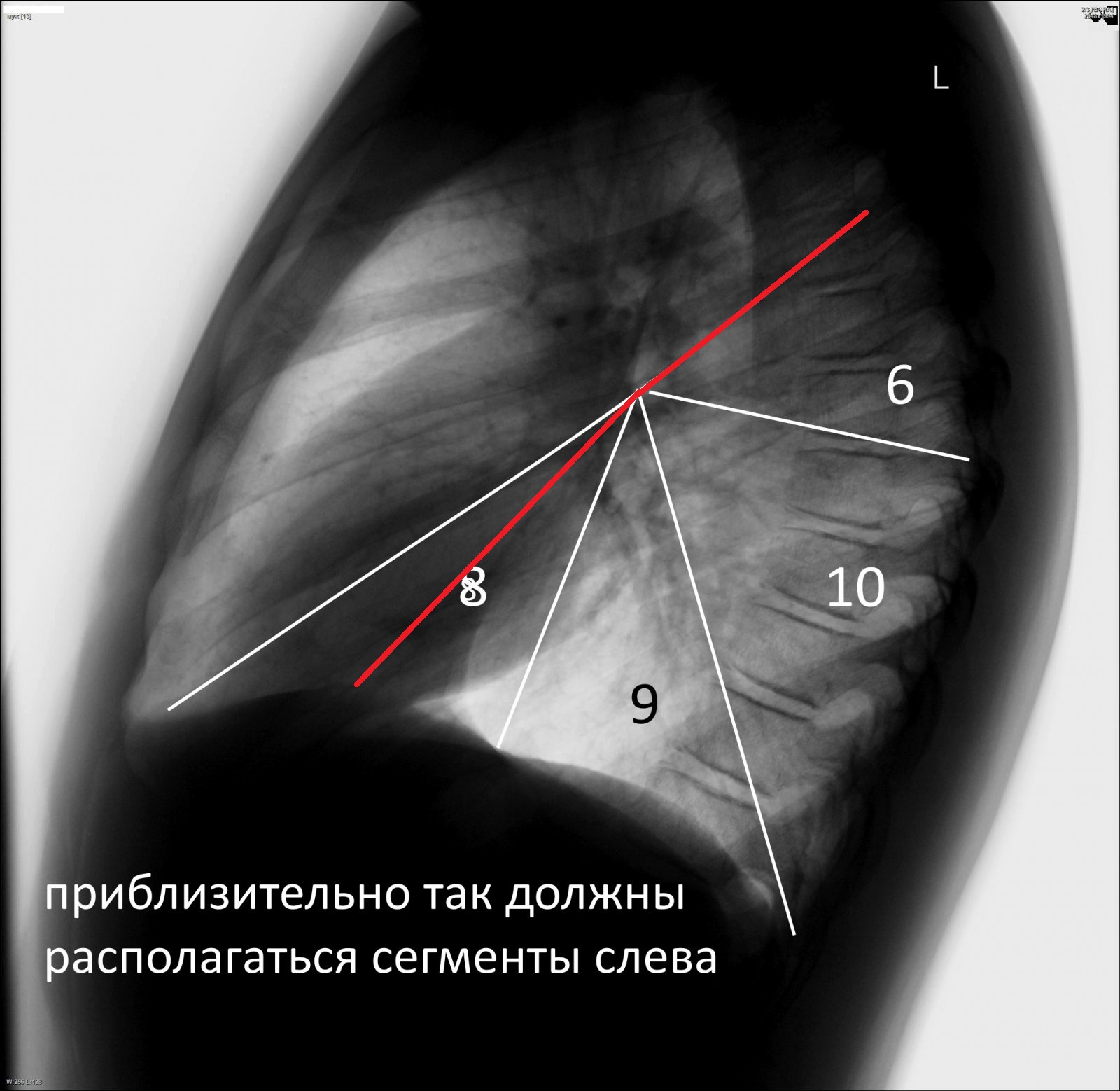 Сегменты легких фото