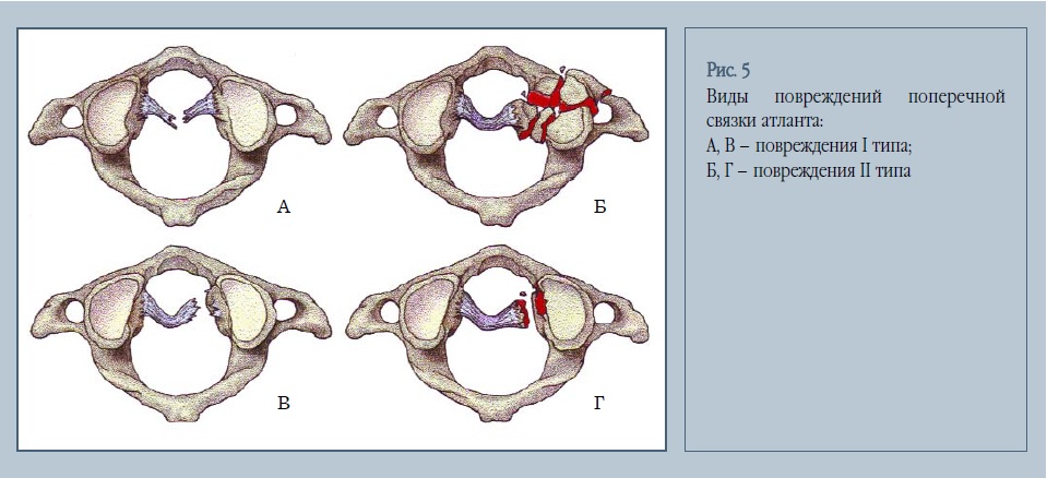 Кт картина ротационного подвывиха атланта
