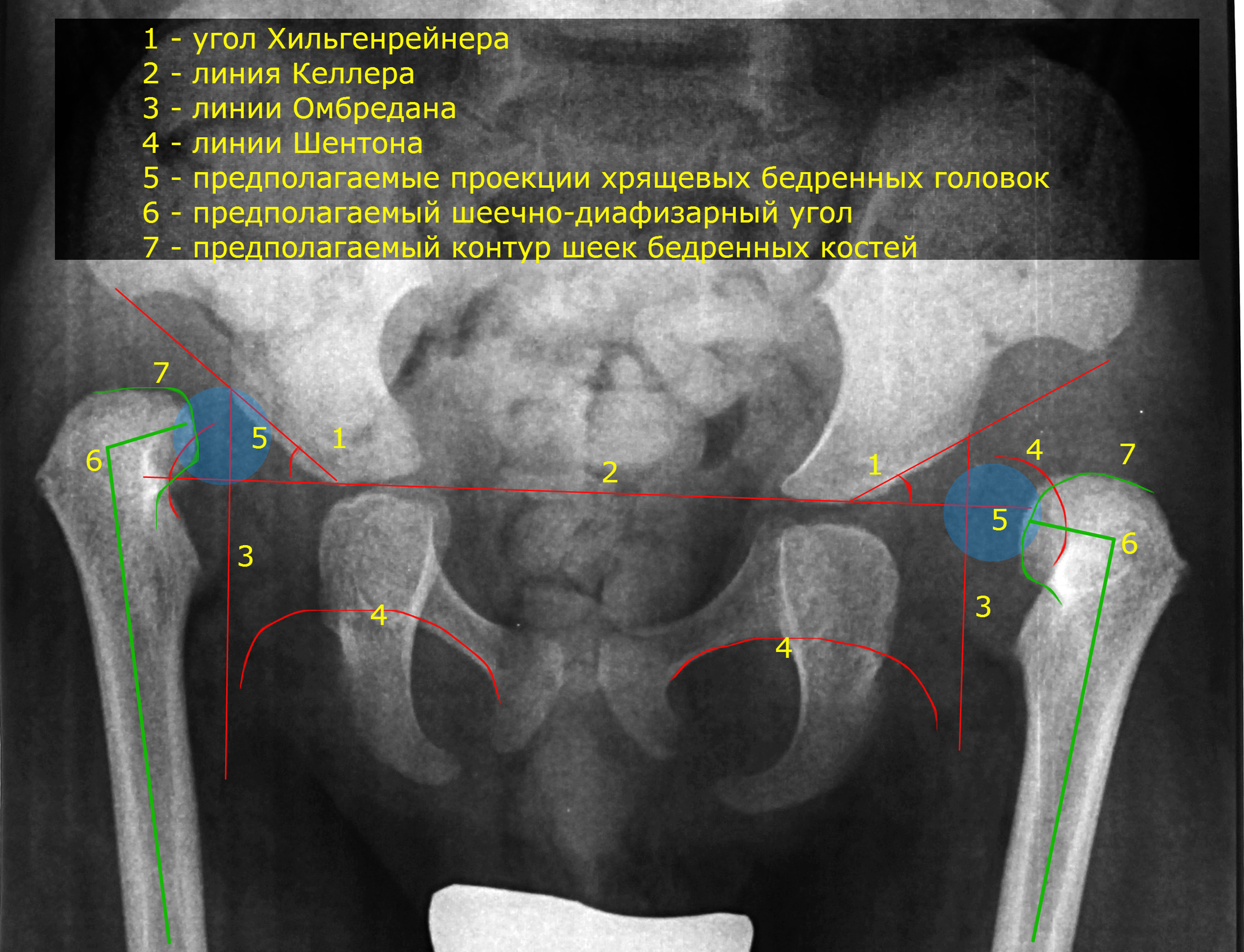 Рентгенодиагностика дисплазии тазобедренных суставов у детей