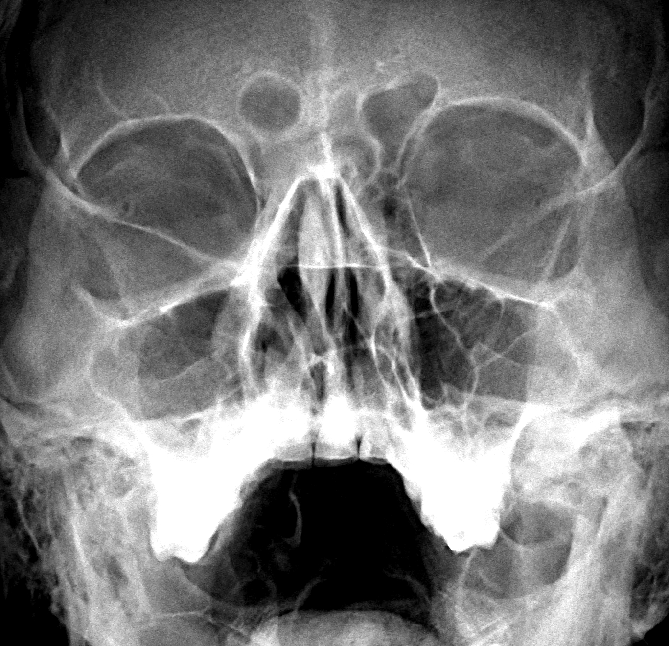 Рентген придаточных пазух носа синусит
