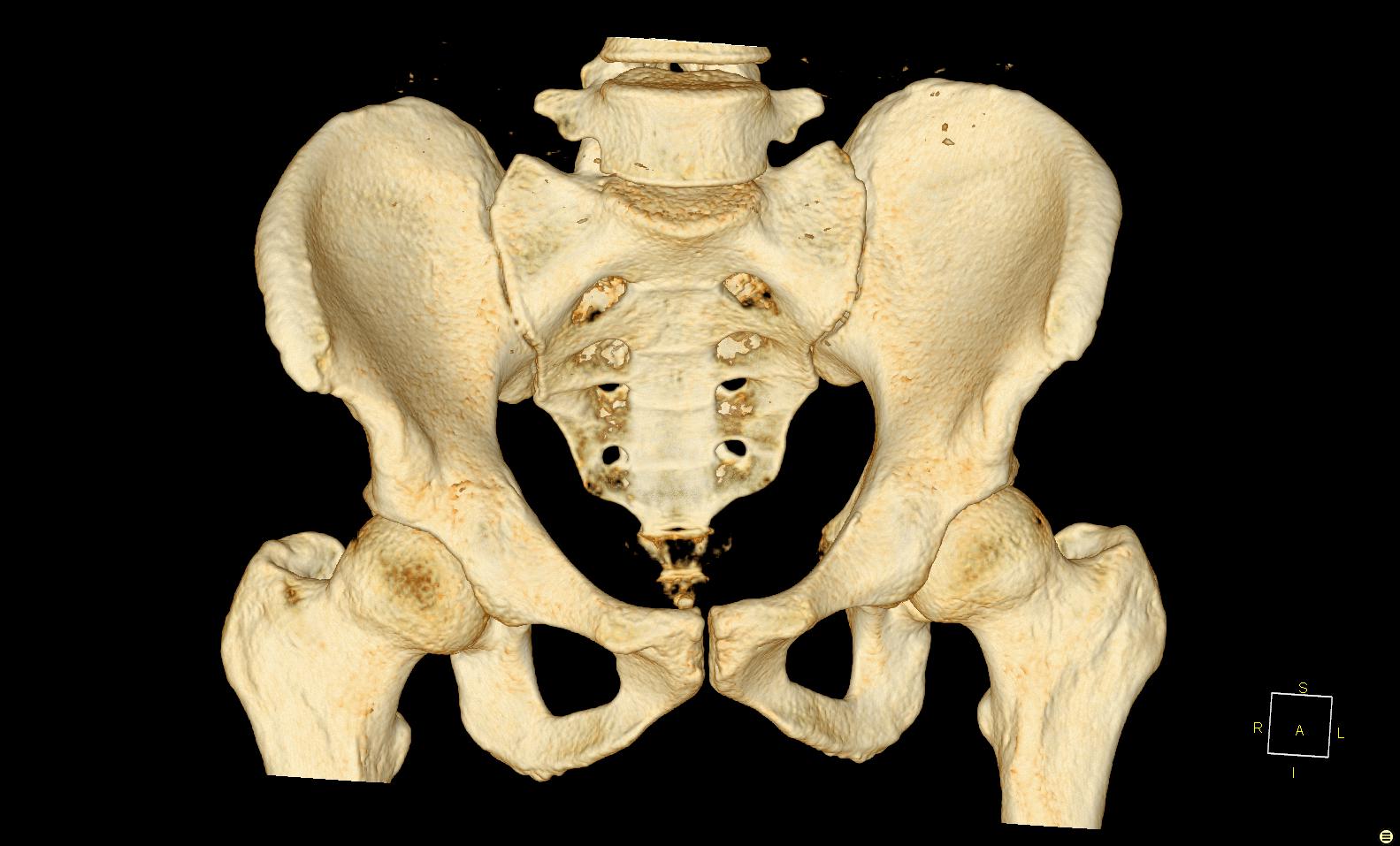Три тазовые кости. Тазовая кость кости. Лонная кость анатомия кт. Седалищная кость скелет. Кости таза анатомия.