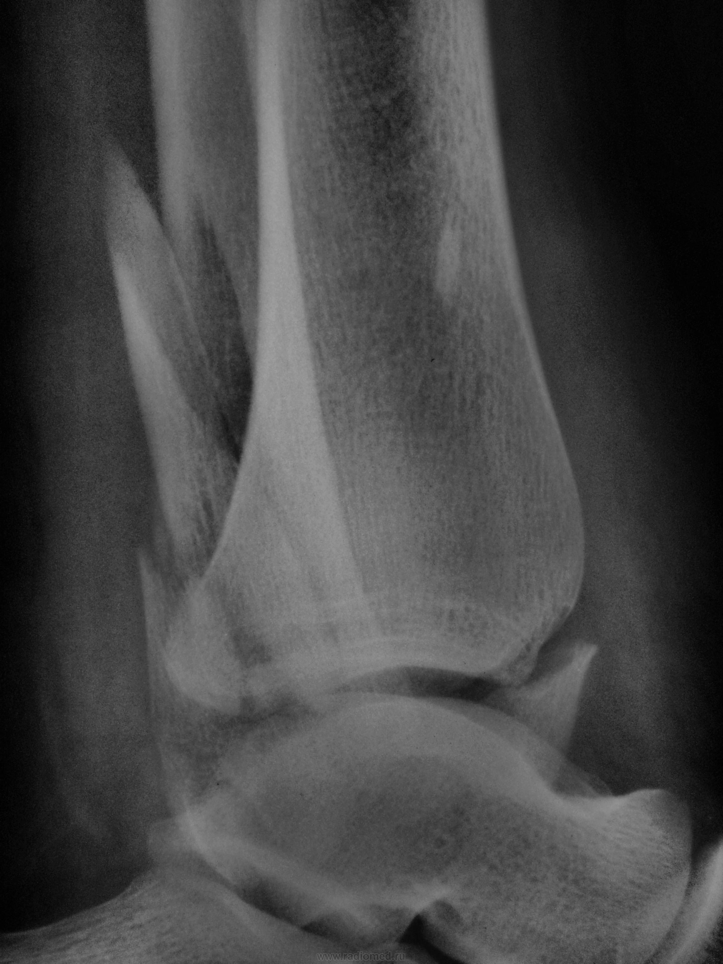Голеностопный сустав рентген. Дисторсия голеностопного сустава рентген. Перелом лодыжки рентген. Перелом голеностопного сустава рентген. Трехлодыжечный перелом рентген.