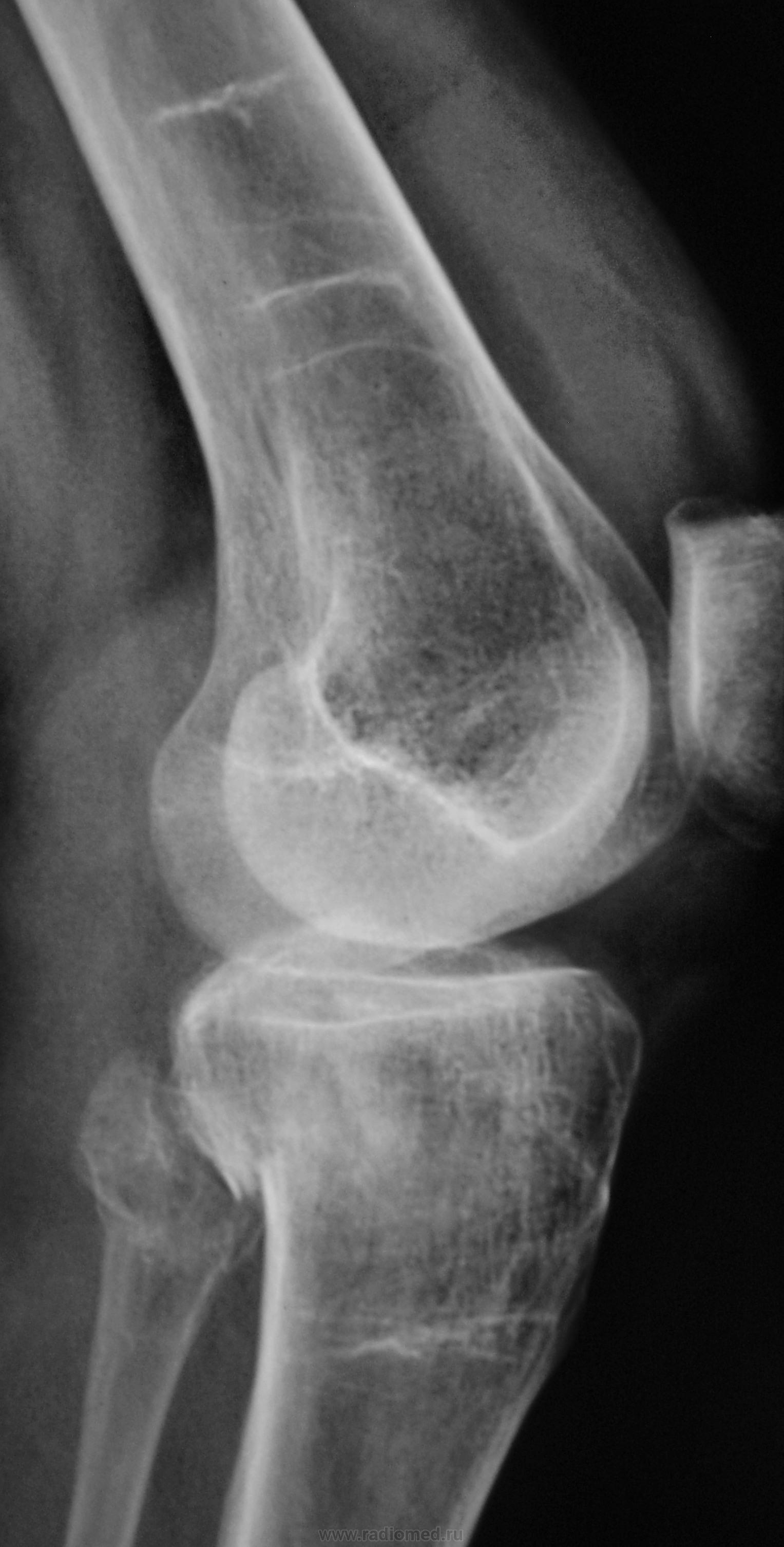 Рентген колена. Рентгенограмма коленного сустава в норме. Левый коленный сустав рентген сбоку. Рентген здорового коленного сустава. Деструкция коленного сустава рентген.