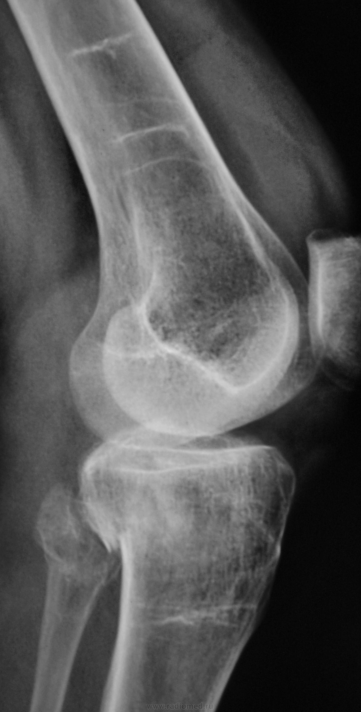 Рентген коленного. Рентгенограмма коленного сустава в норме. Левый коленный сустав рентген сбоку. Рентген здорового коленного сустава. Деструкция коленного сустава рентген.