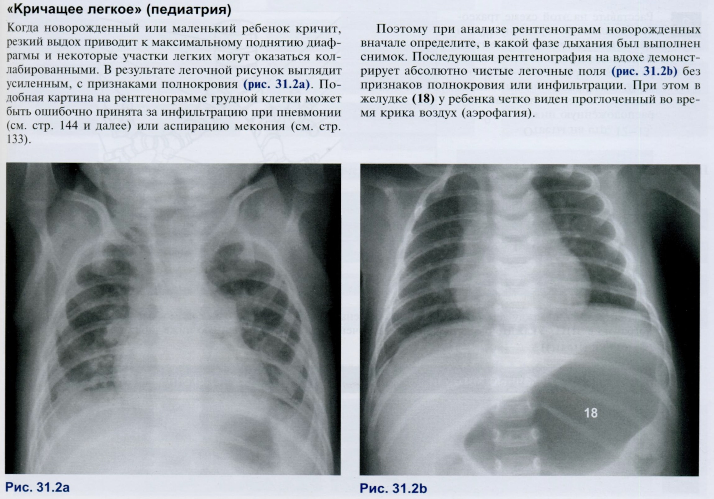Пневмония у новорожденного рентген