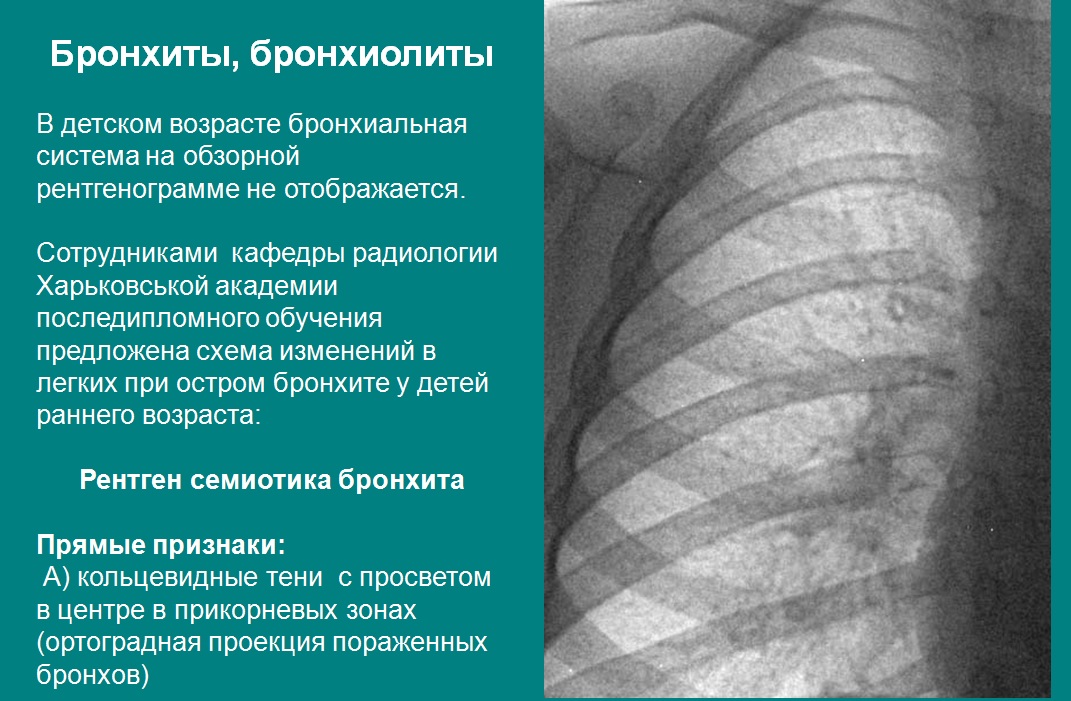 Бронхиолит у детей рентгенологическая картина