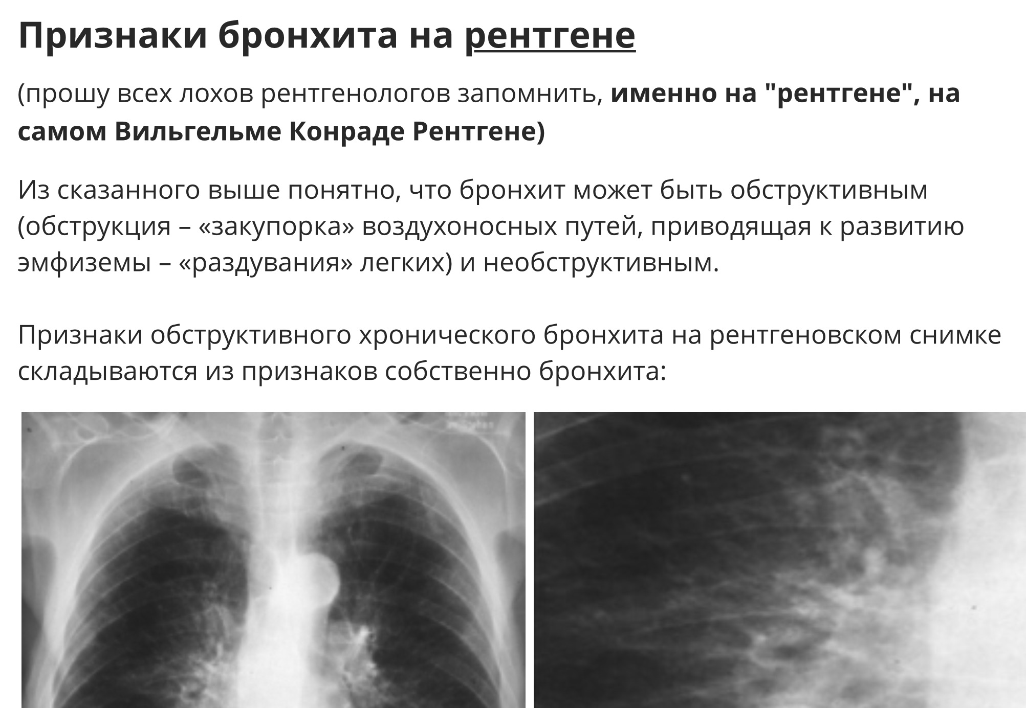 Рентген при бронхите: описание, как выглядит, признаки