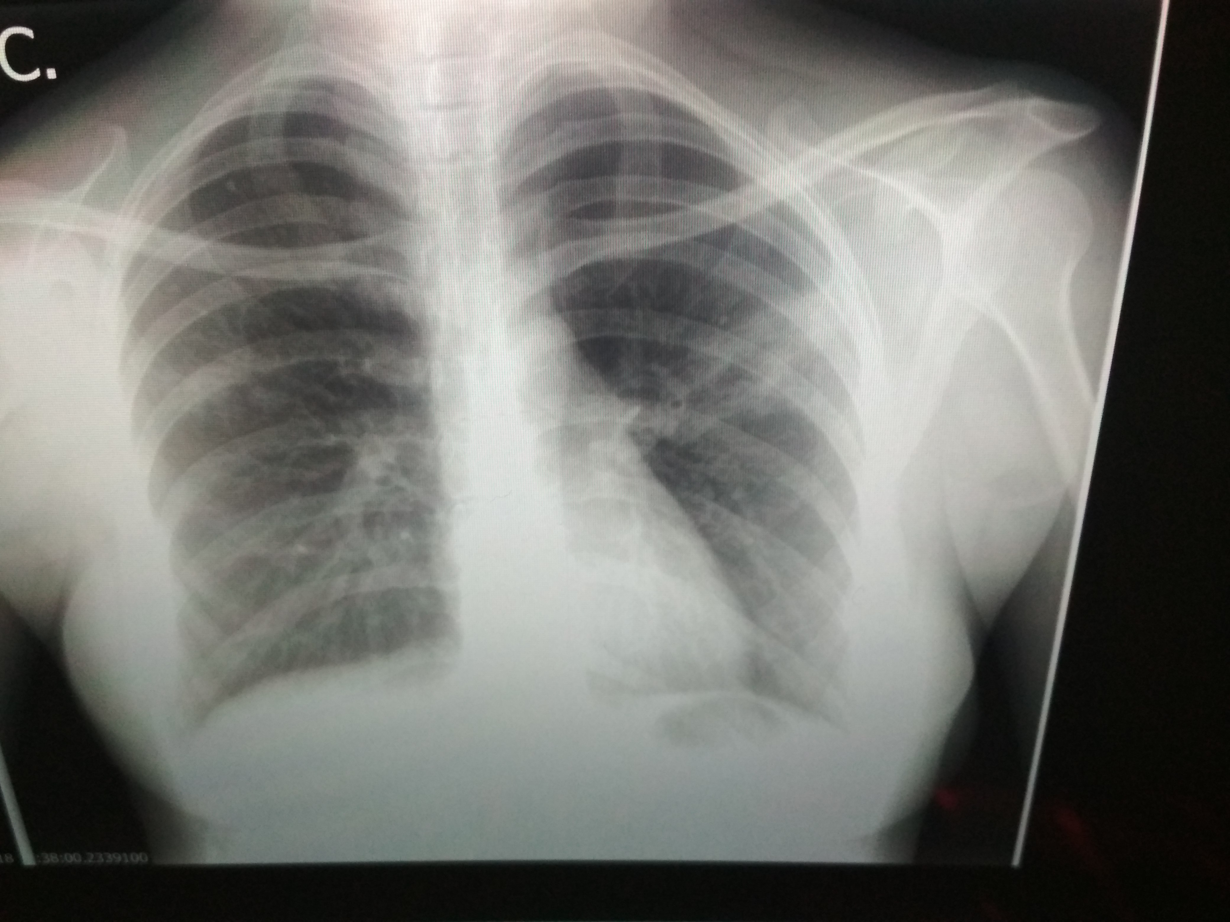 Рентген при туберкулезе и пневмонии