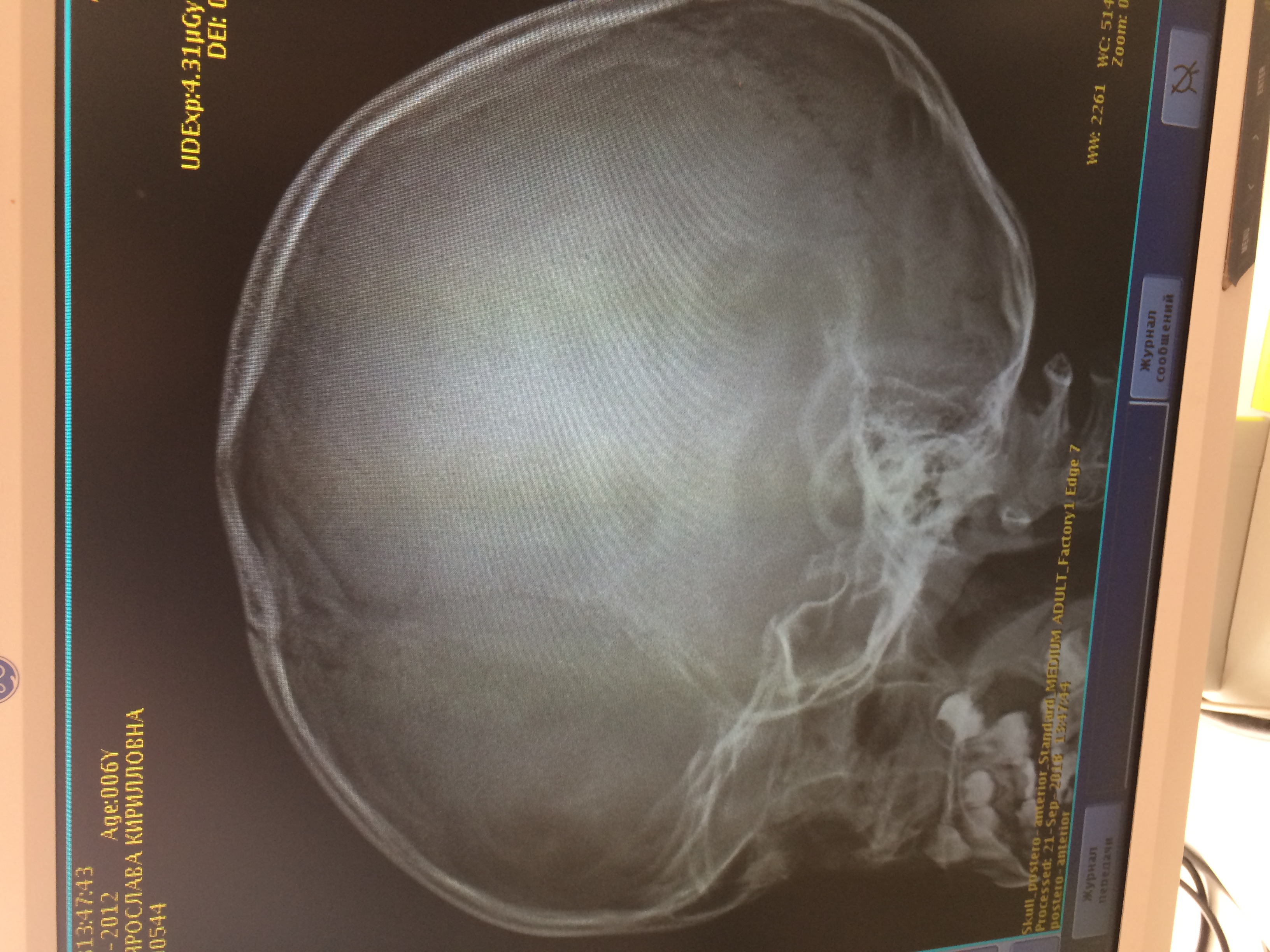 Детский череп рентген. Снимок черепа ребенка рентгеновский. Детский череп рентген снимок. Снимок рентгена черепа младенца.