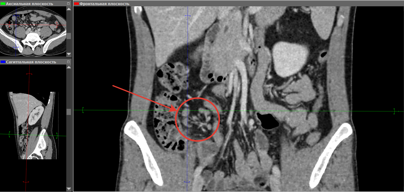Мскт брюшной. Корональная плоскость кт. Плоскости компьютерной томографии. Аксиальная плоскость кт.