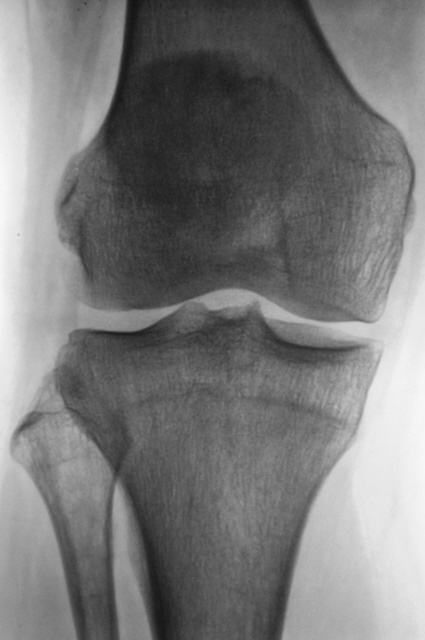 Лигаментоз крестообразных связок коленных. Тендиноз коленного сустава рентген. Лигаментоз коленного сустава рентген. Лигаментоз надколенника рентген. Оссифицирующий тендиноз коленного сустава.