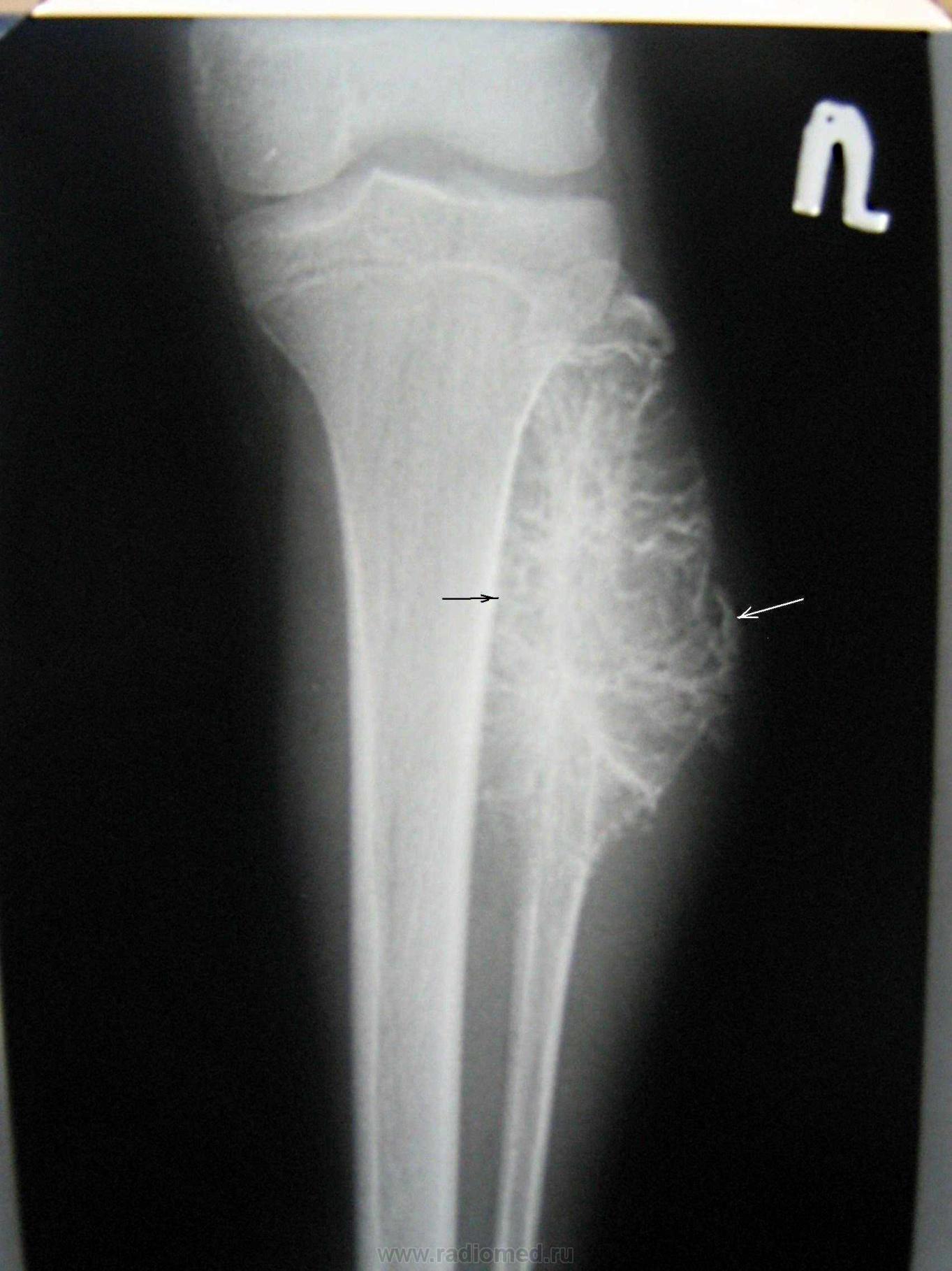 Саркома юинга. Саркома Юинга большеберцовой кости кт. Хондросаркома большеберцовой кости рентген. Остеогенная саркома Юинга.