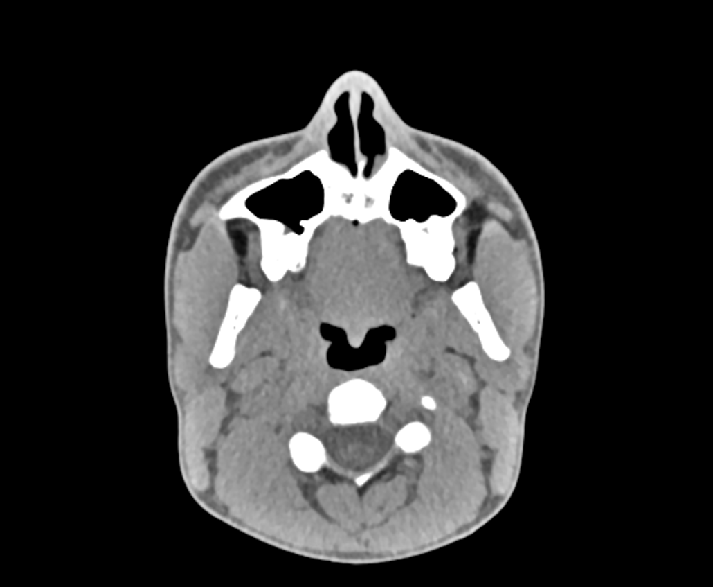 Киста Торнвальда на КТ носоглотки